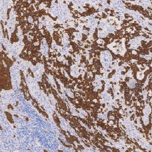 鼠抗人细胞角蛋白5/6单克隆抗体  TDCCM-0983