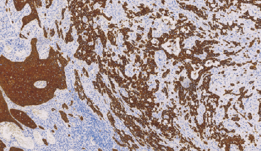 鼠抗人细胞角蛋白5/6单克隆抗体  TDCCM-0983