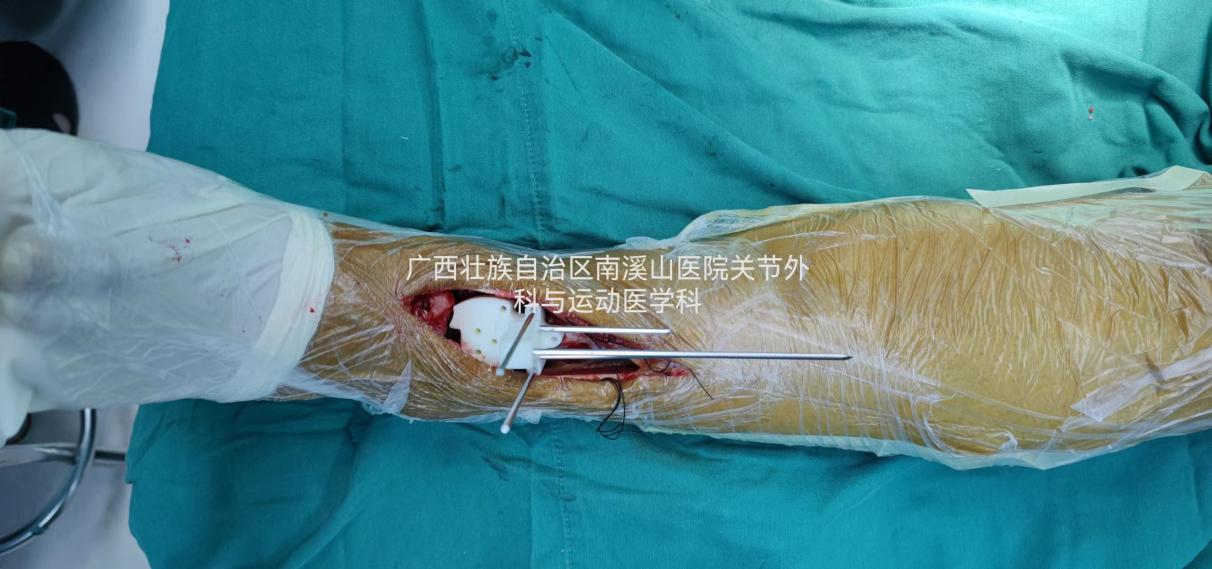 自治区南溪山医院完成定制化人工踝关节置换