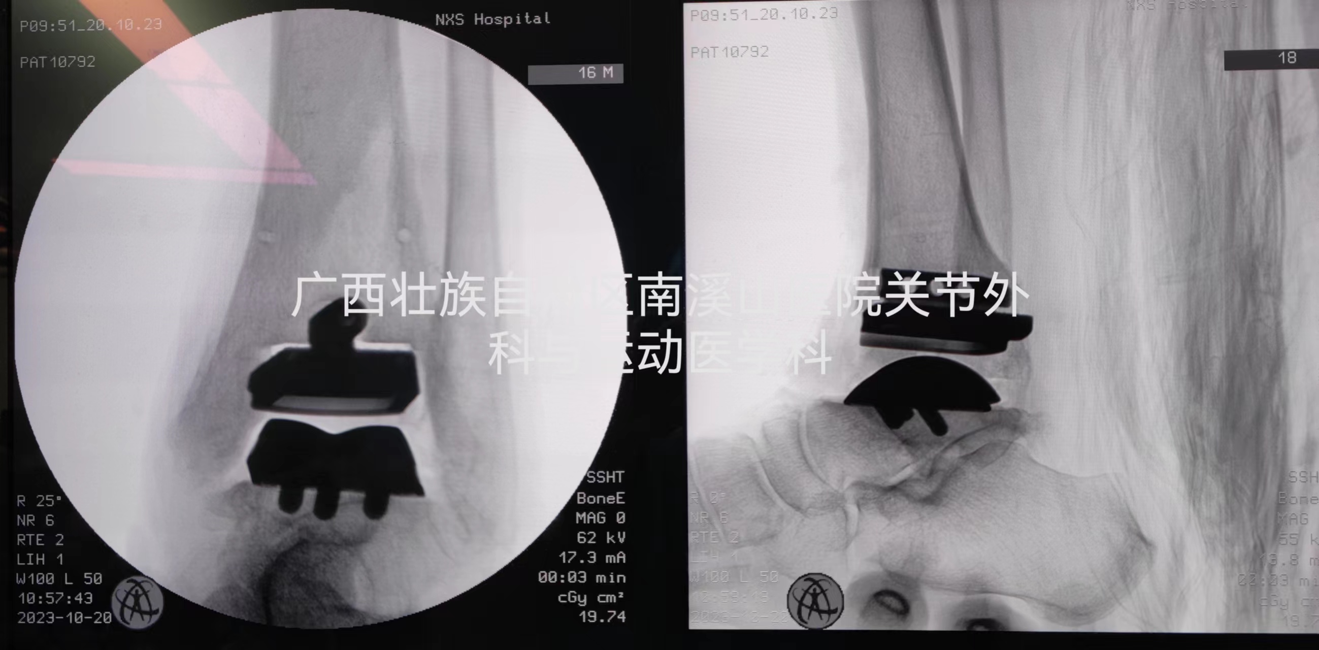 自治区南溪山医院完成定制化人工踝关节置换