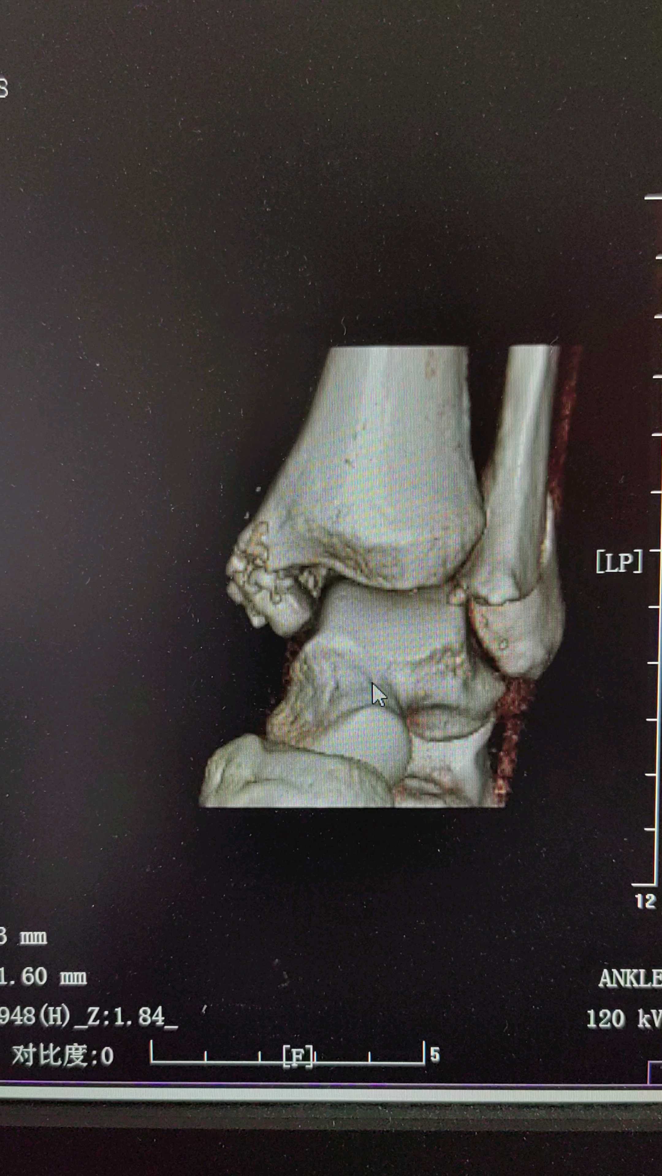 转来我院后,三维重建ct如下:外院首诊片肢体照治疗方案:闭合复位外