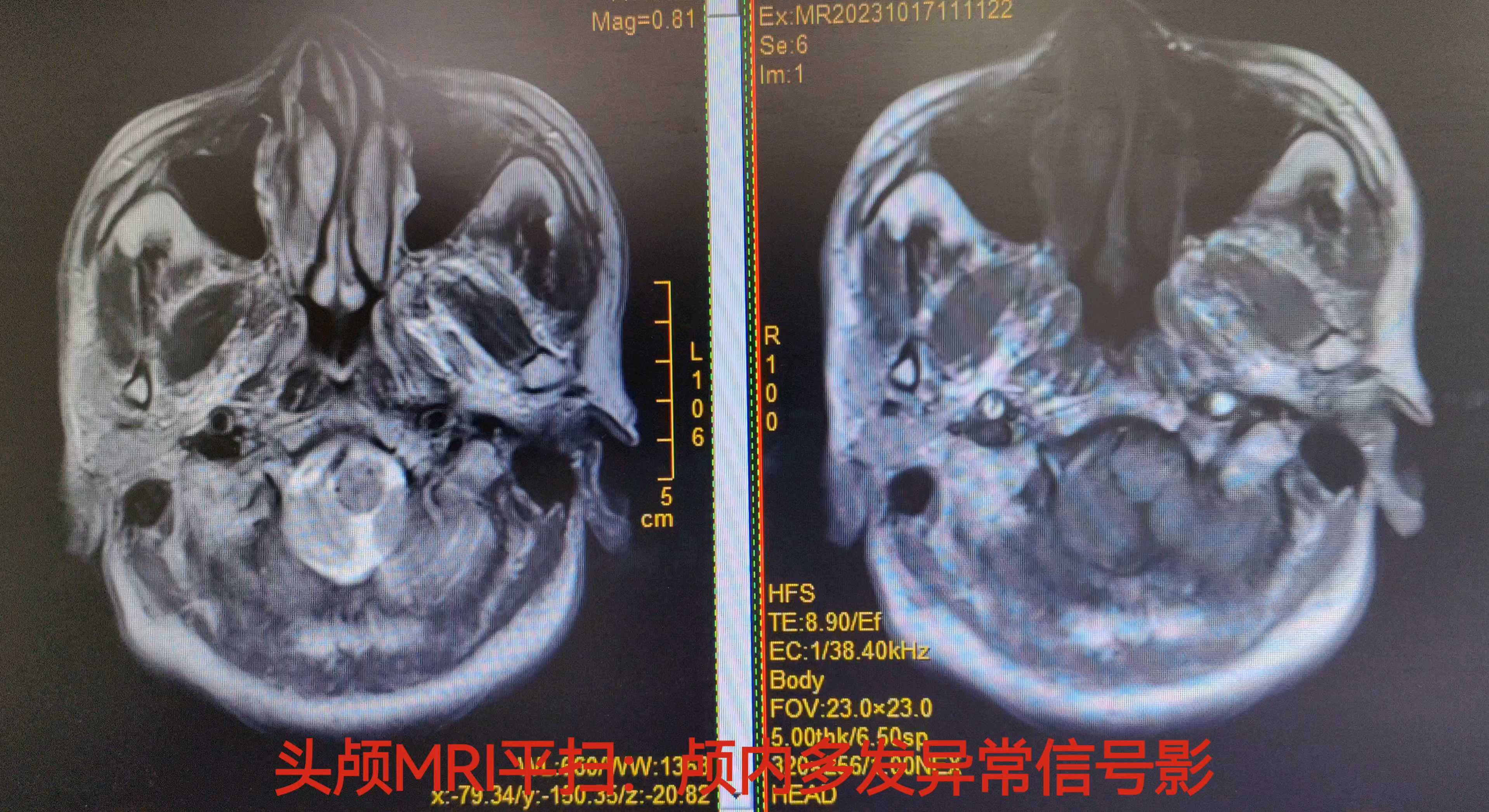 影像学下的中枢神经系统占位性病变