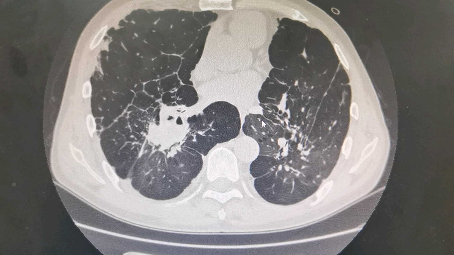 討論右肺新增的病灶考慮什麼感染