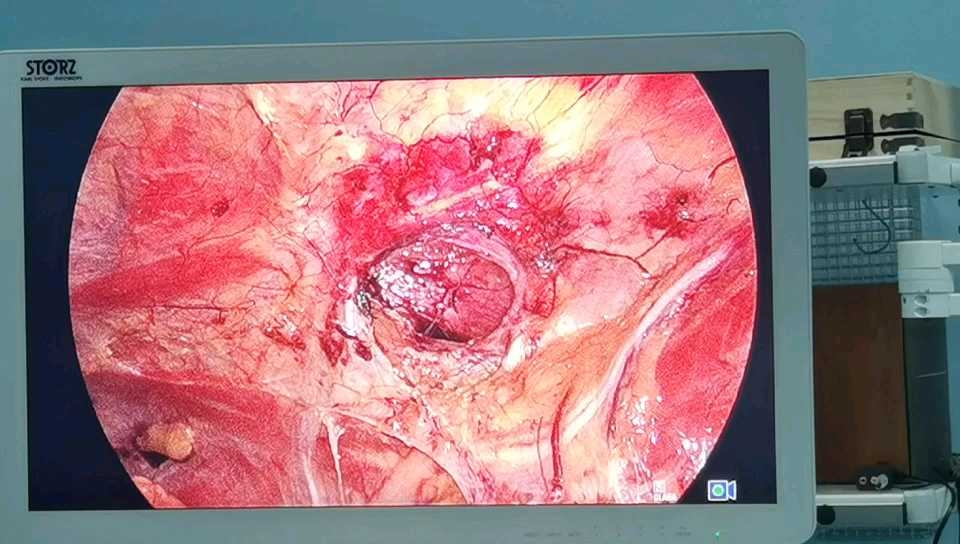 下腰疝vs下腰疝rtep下視頻講解