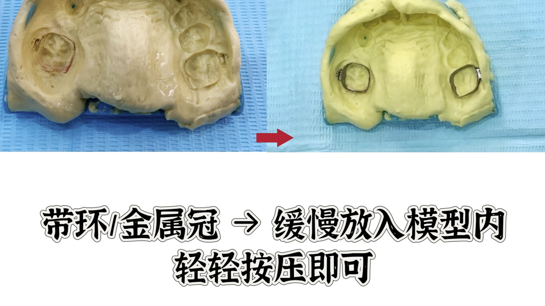 间隙保持器价格表图片