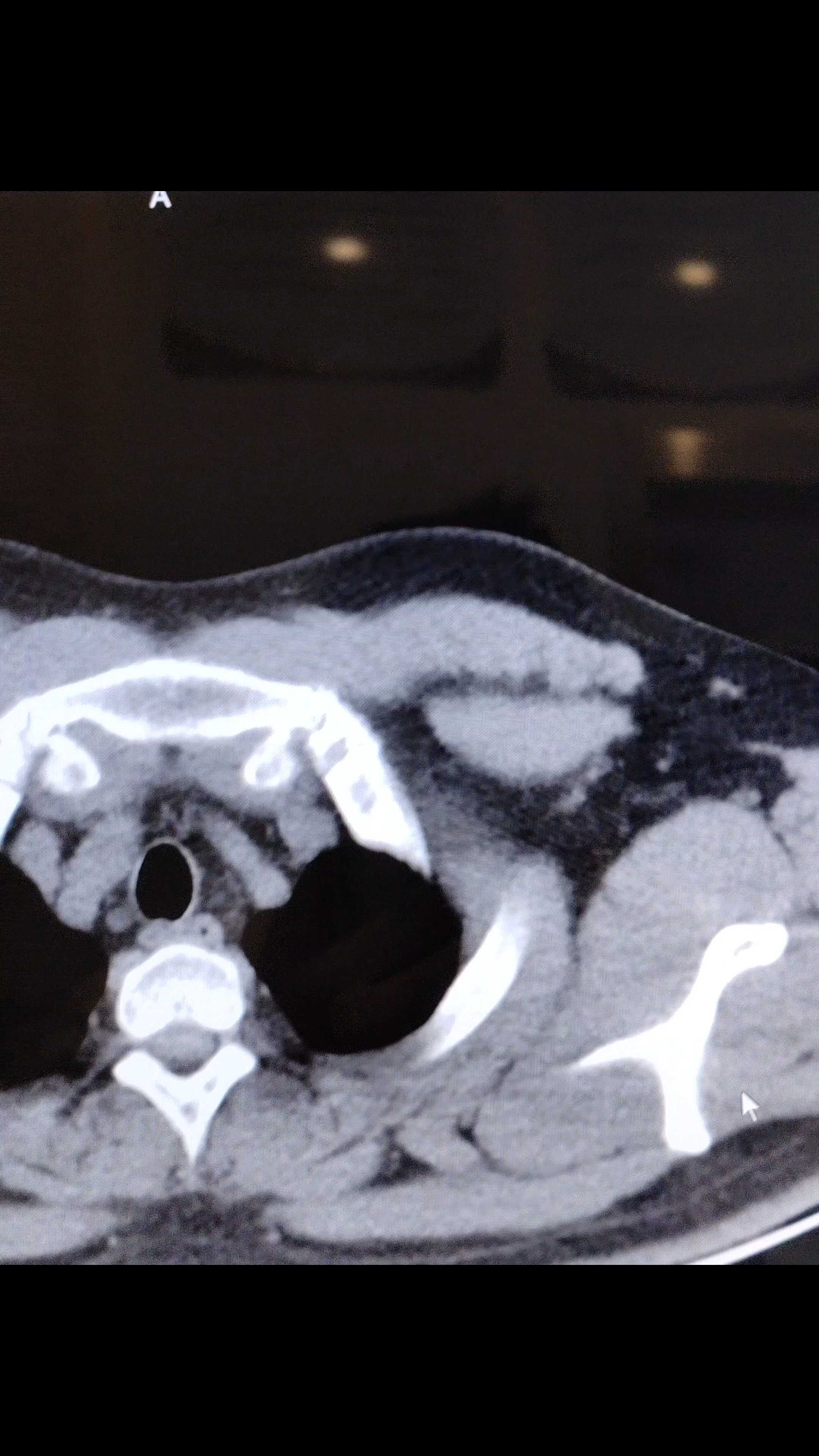 这个永存左上腔静脉引流到哪了?