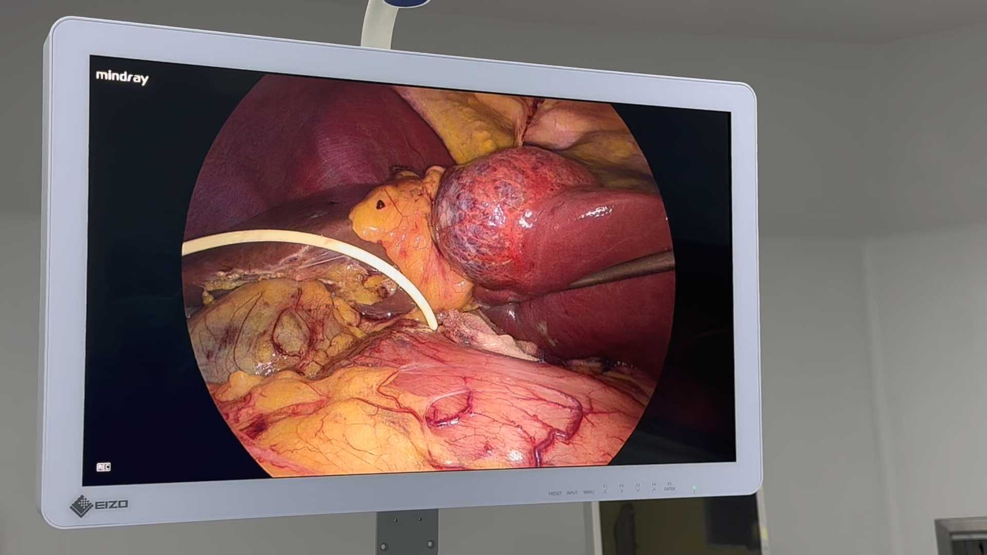 腹腔镜下肝s3血管瘤切除术