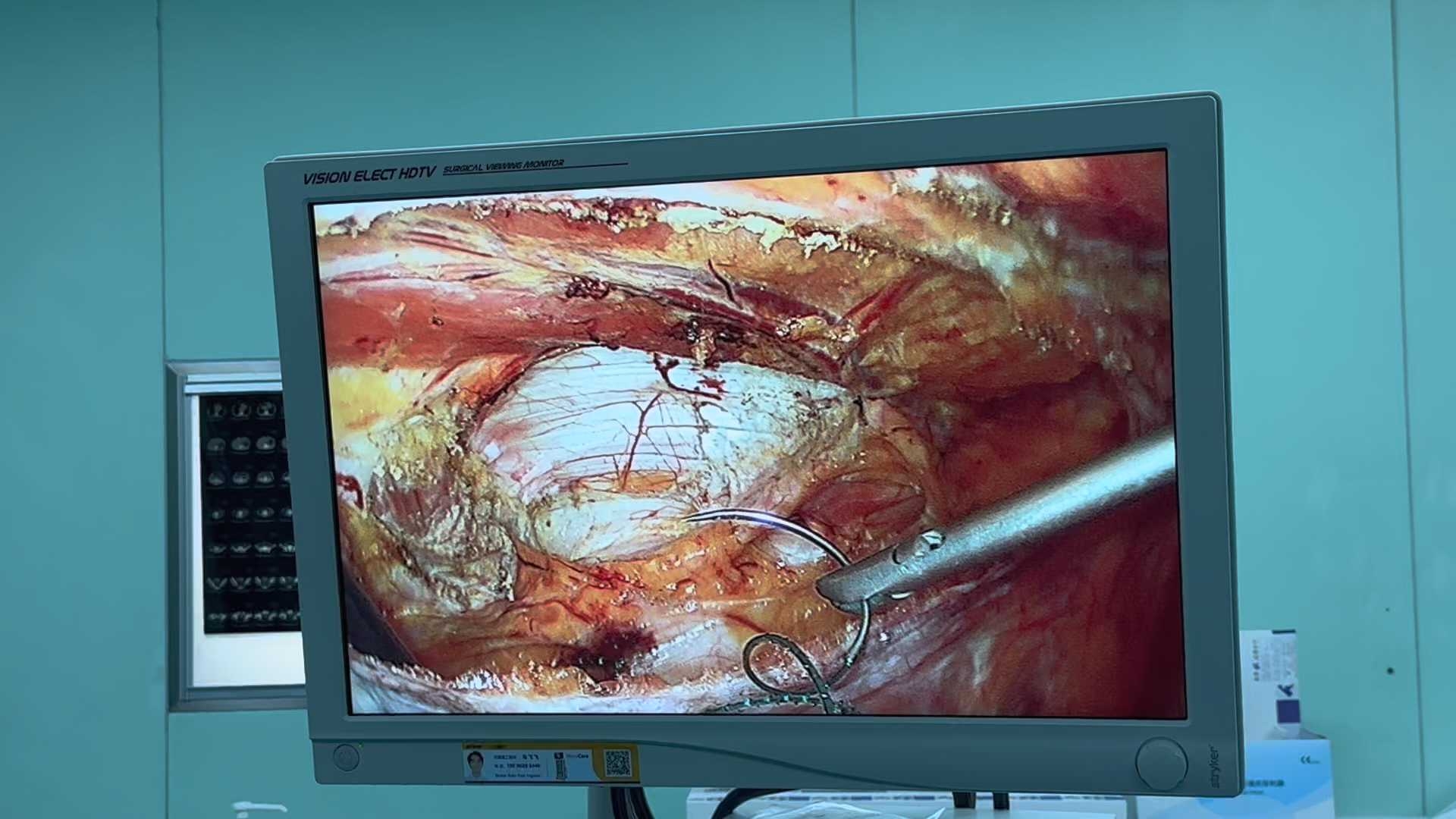 左侧腹壁半月线疝tapp修补技术
