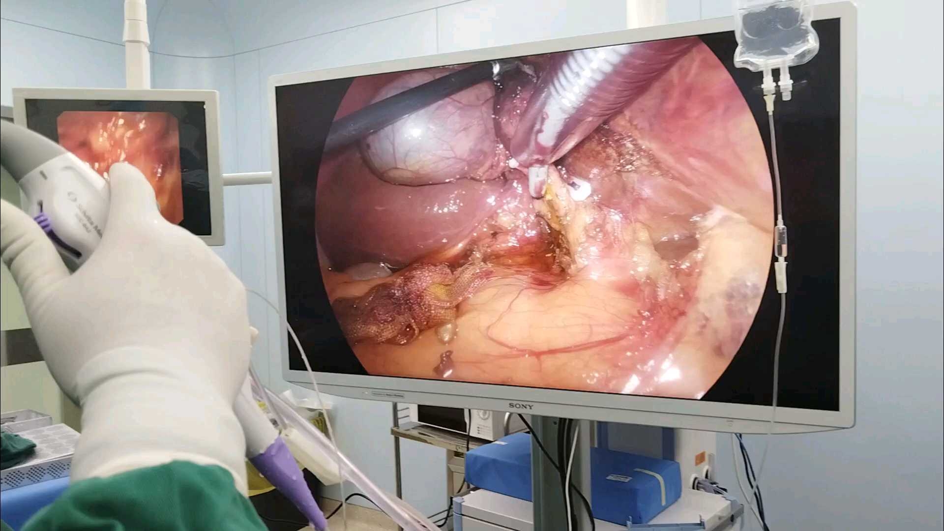 胆总管结石手术图片图片