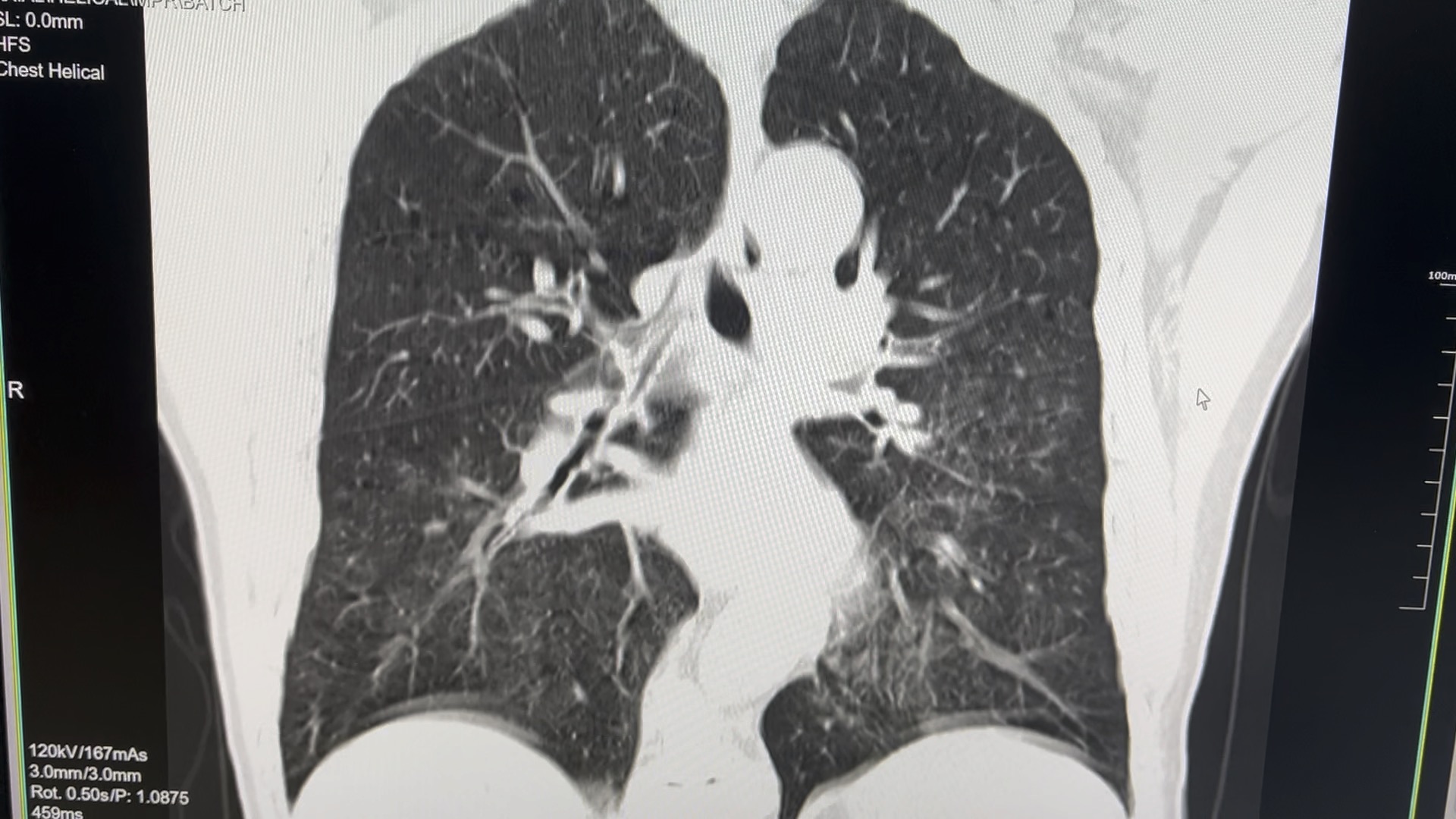 间质性肺水肿待定