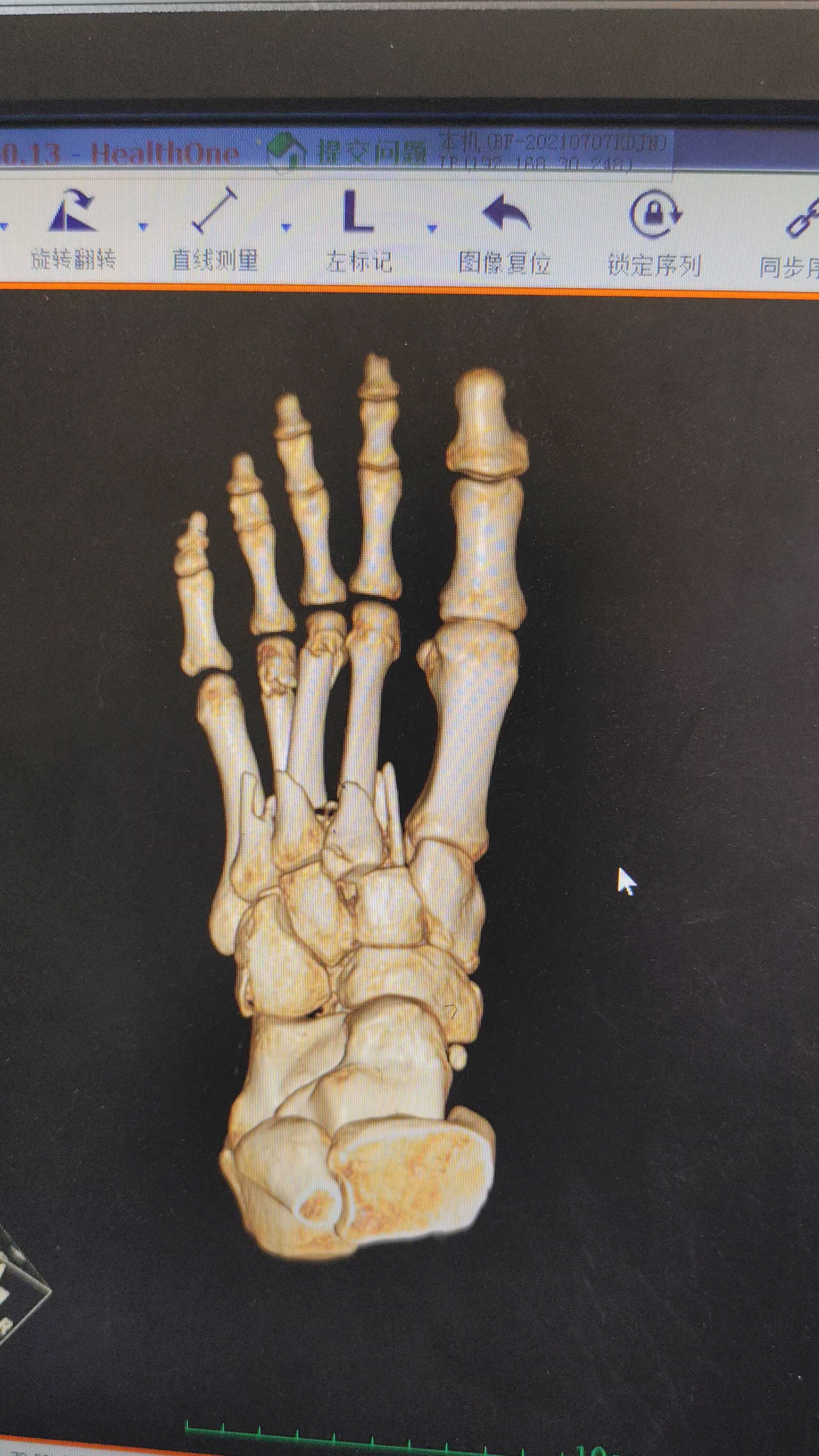 严重lisfranc损伤求治疗方案!