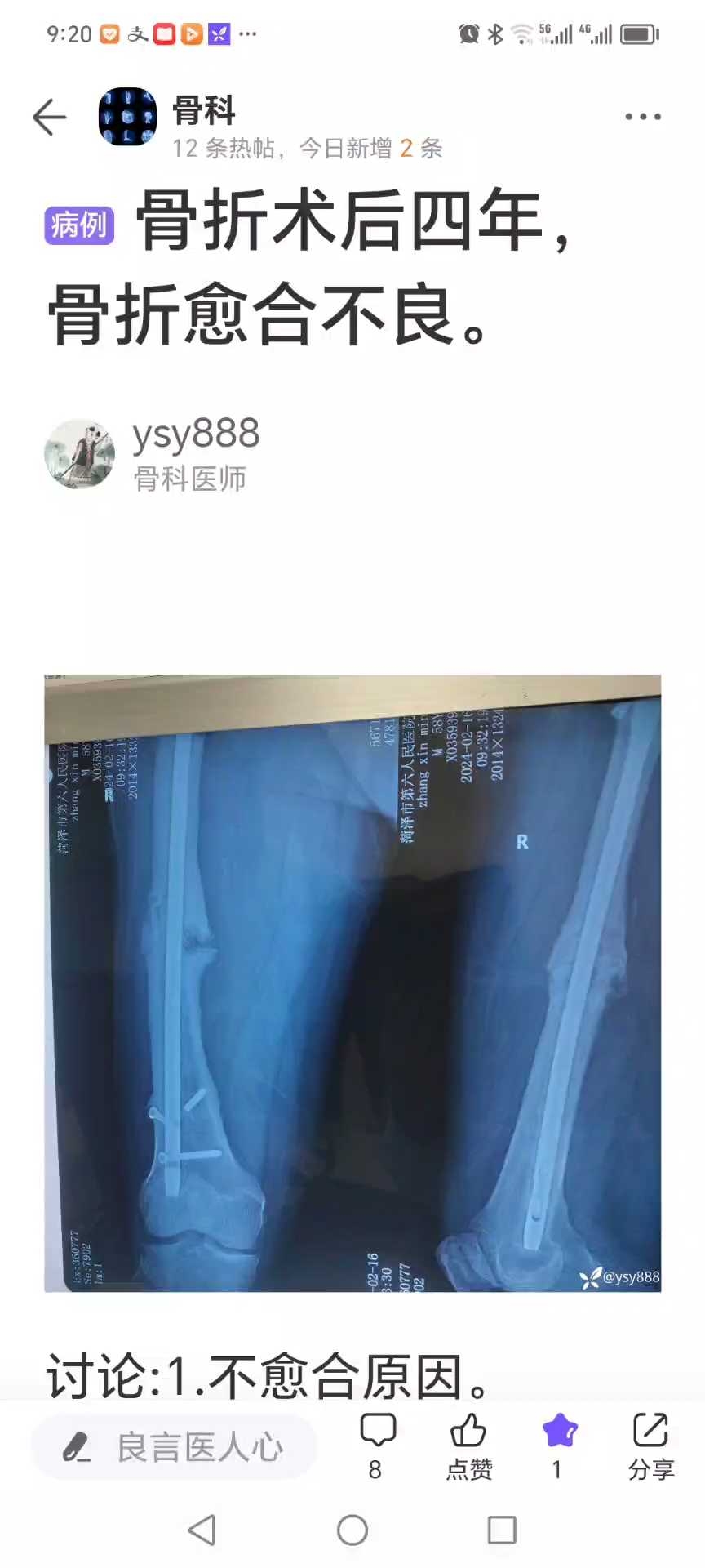 骨科ao原则陷阱之二交锁髓内钉系统固定骨不连膨胀性生长及失效