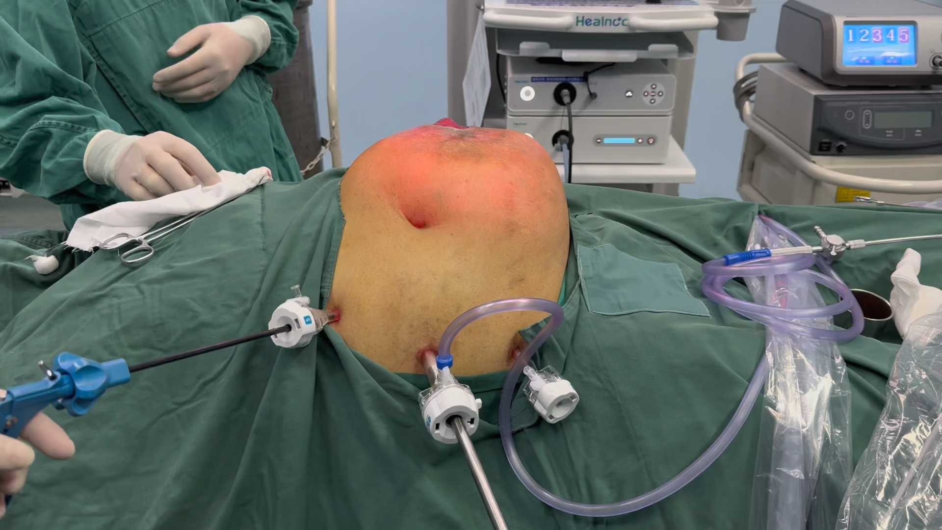 腹腔镜下造口旁疝sugarbaker补片修补主动减容造口重建上