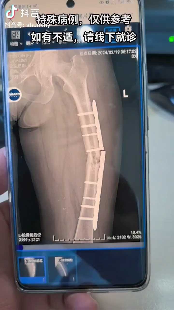 骨科ao原则陷阱