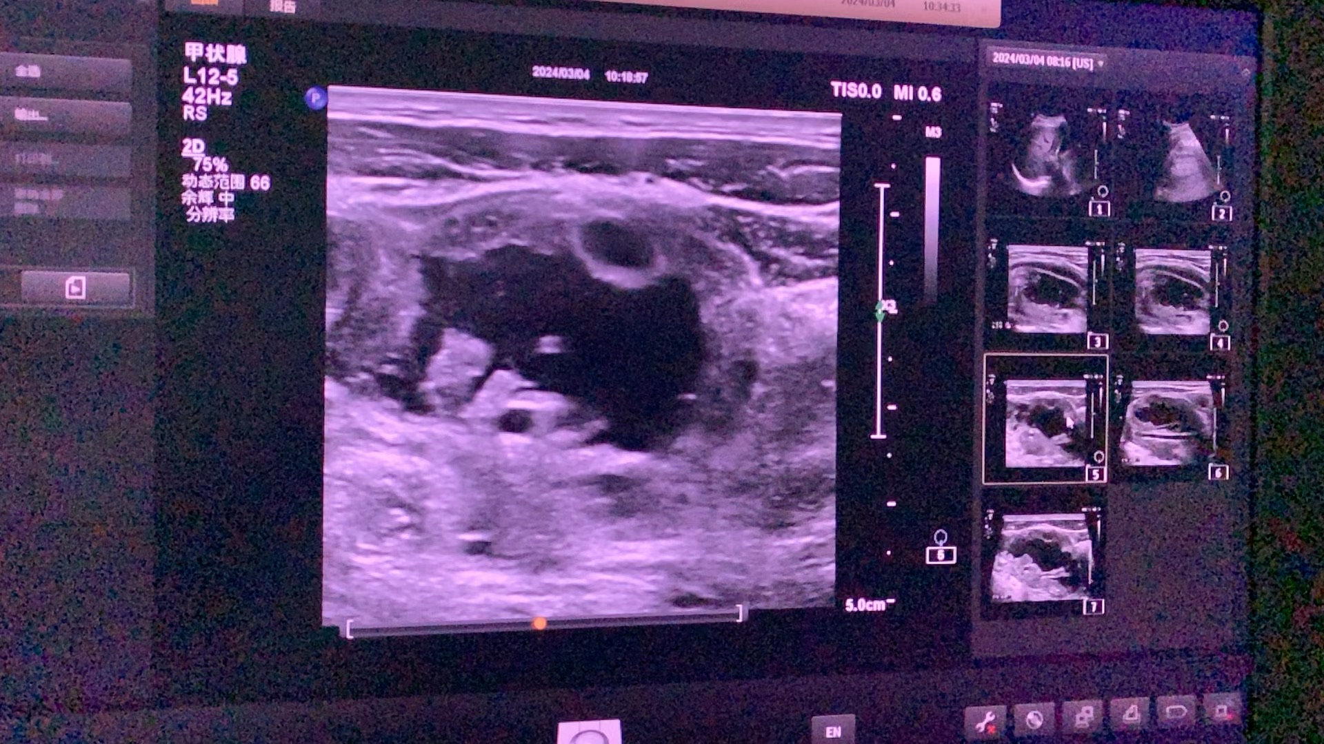 右侧颈部巨大囊性包块