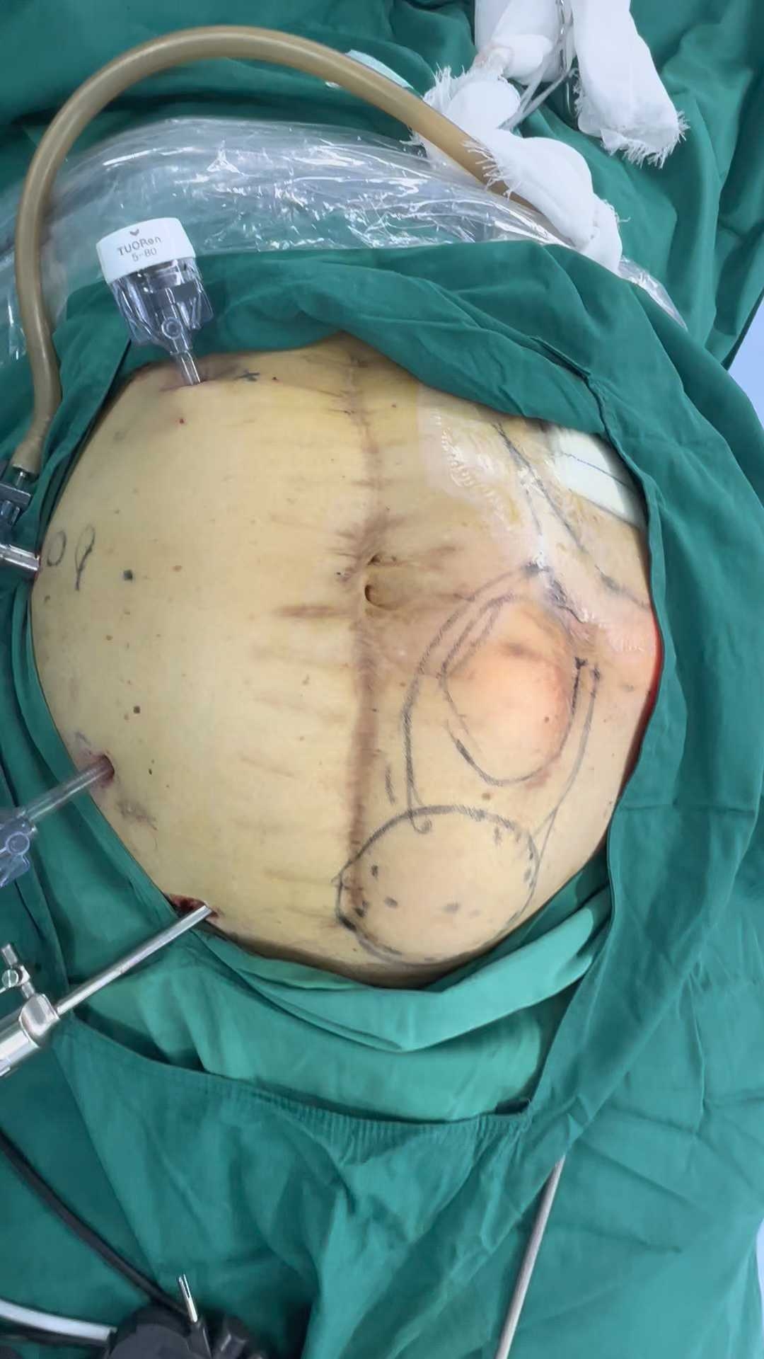 造口旁疝切口疝腹腔镜ipomsugarbaker修补术