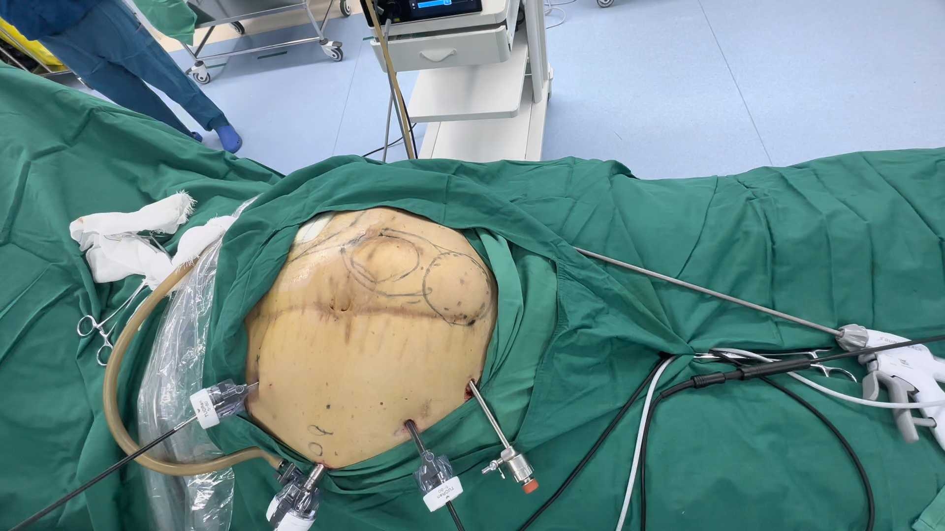 腹腔镜下疝修补术tapp图片