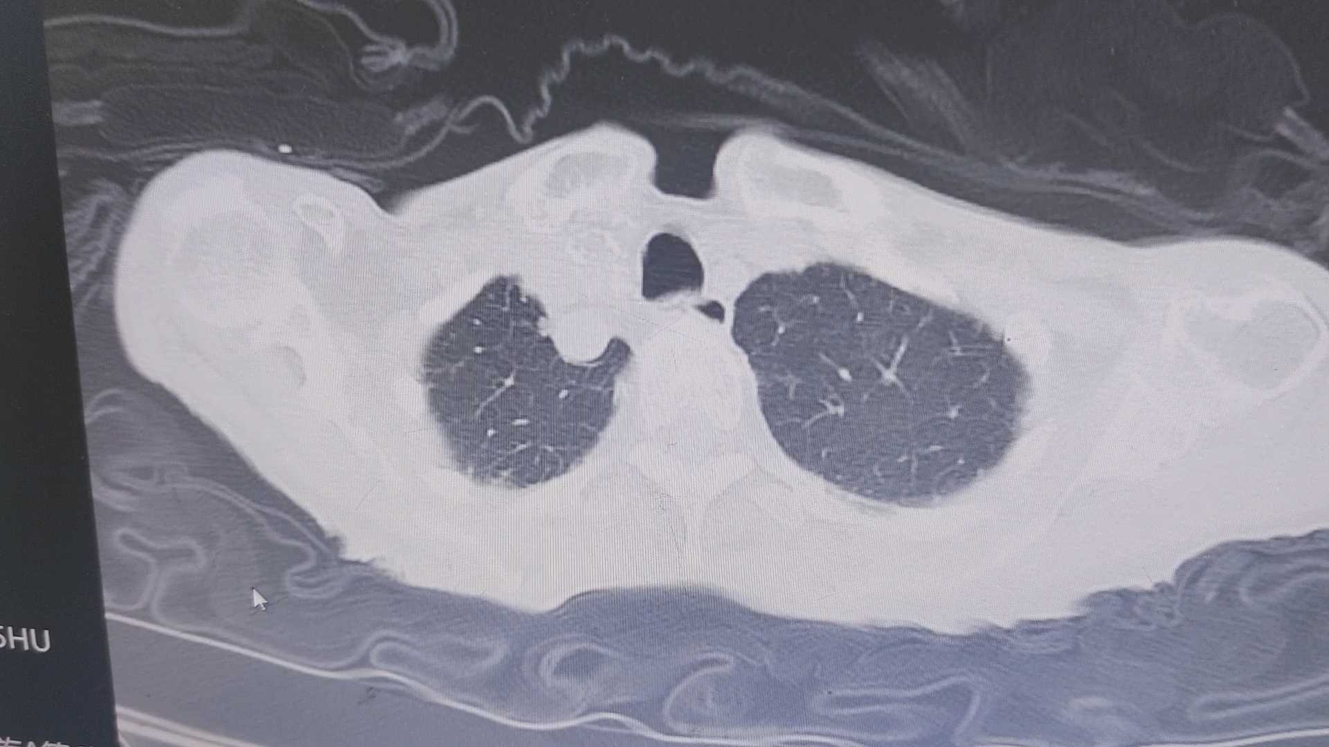 新冠肺炎后的老婆婆