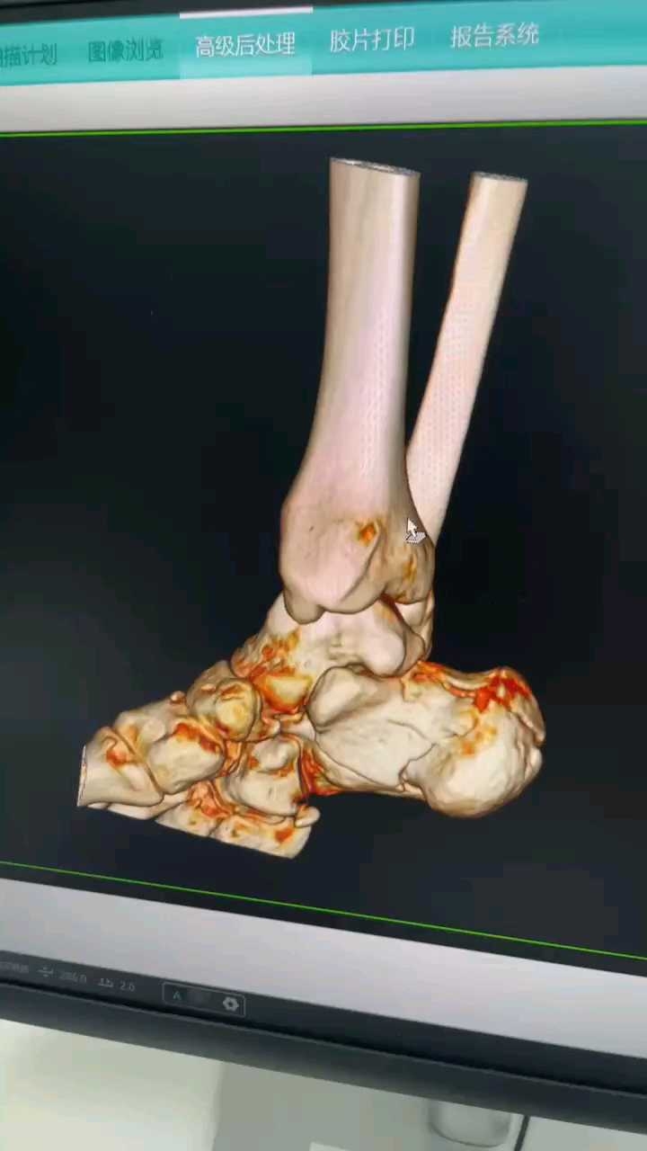 骨科ct三维询问