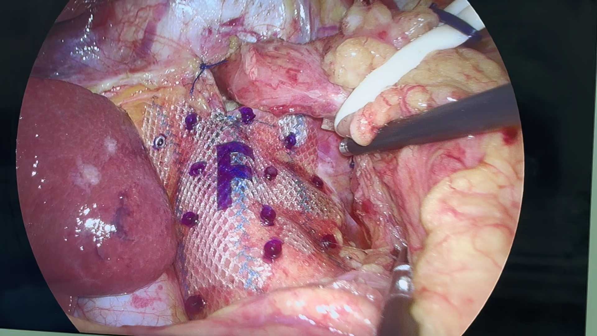 腹腔镜食管裂孔疝补片修补胃底折叠术