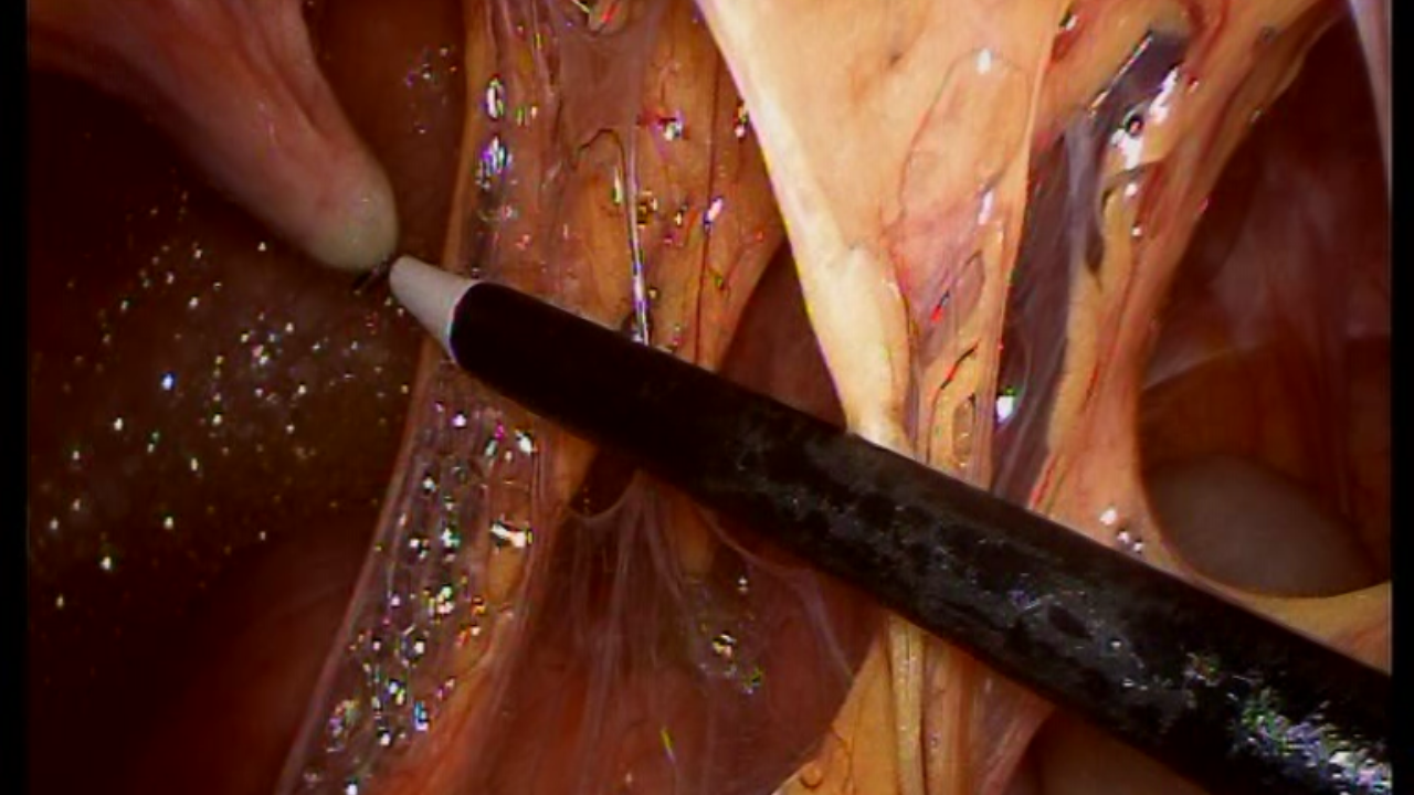 腹腔镜手术下腹壁trocar穿刺的窘境和小技巧