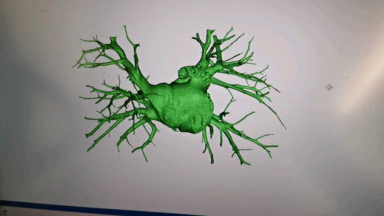 反鸡翅型心耳形态分享