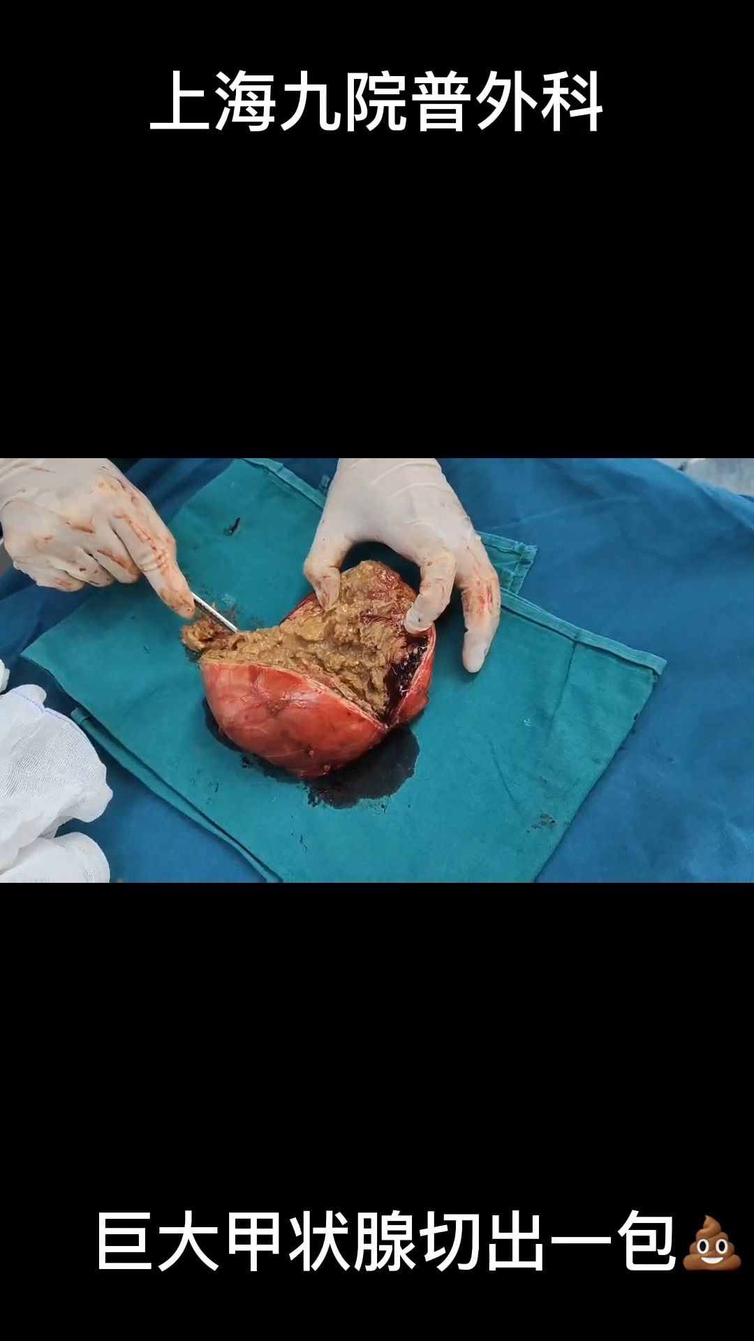 甲状腺肿物切出来一坨💩