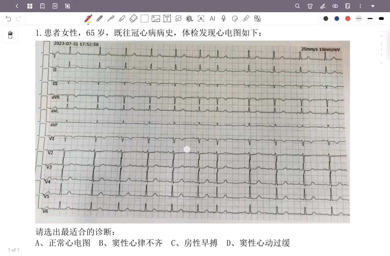 房性早搏的心电图特征图片