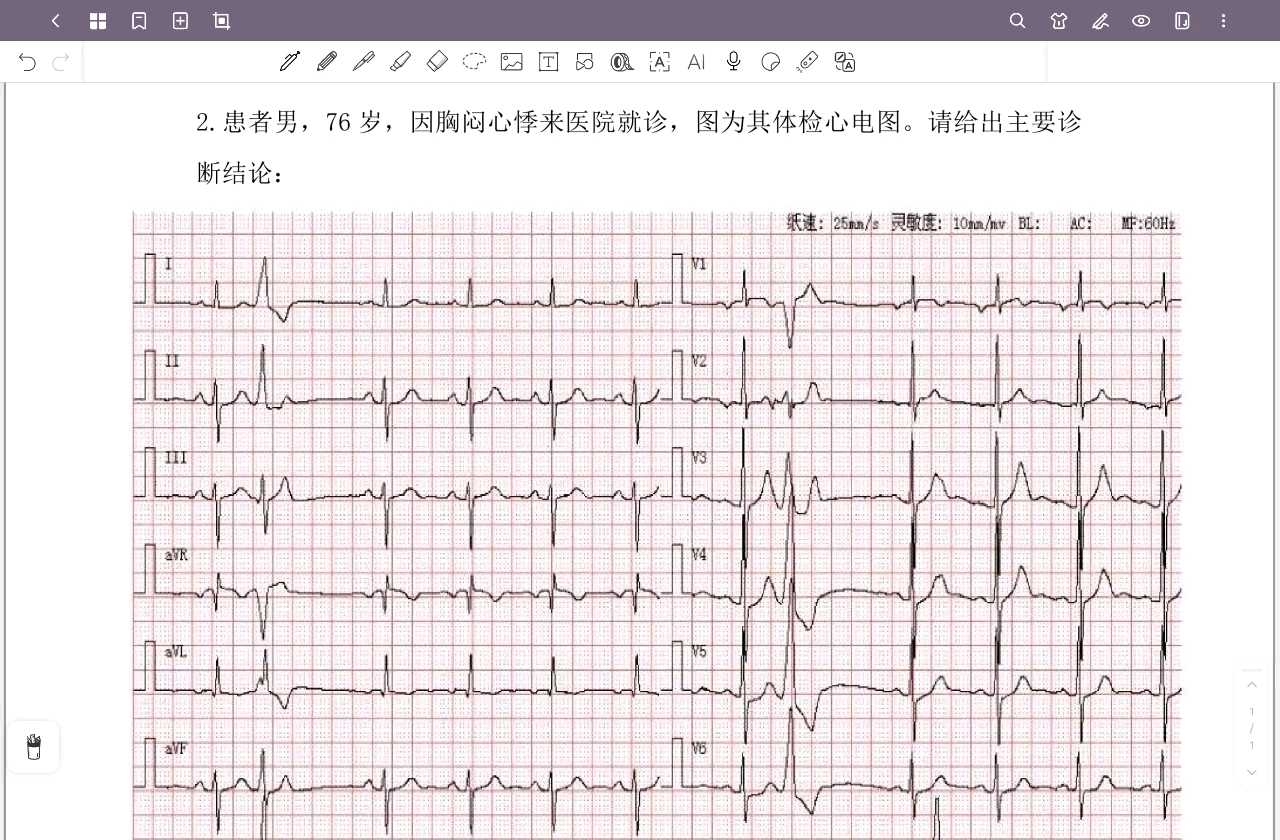 室性早搏的心电图特点