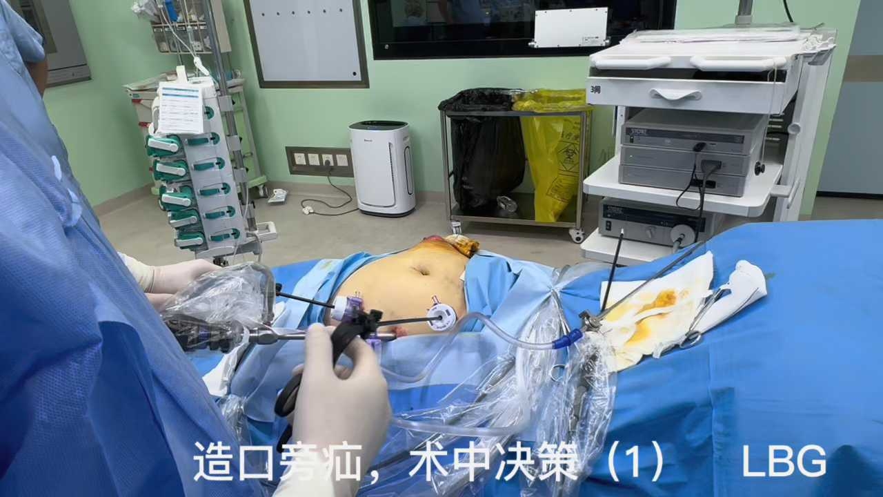 造口还瘘 腔镜下tape修补术