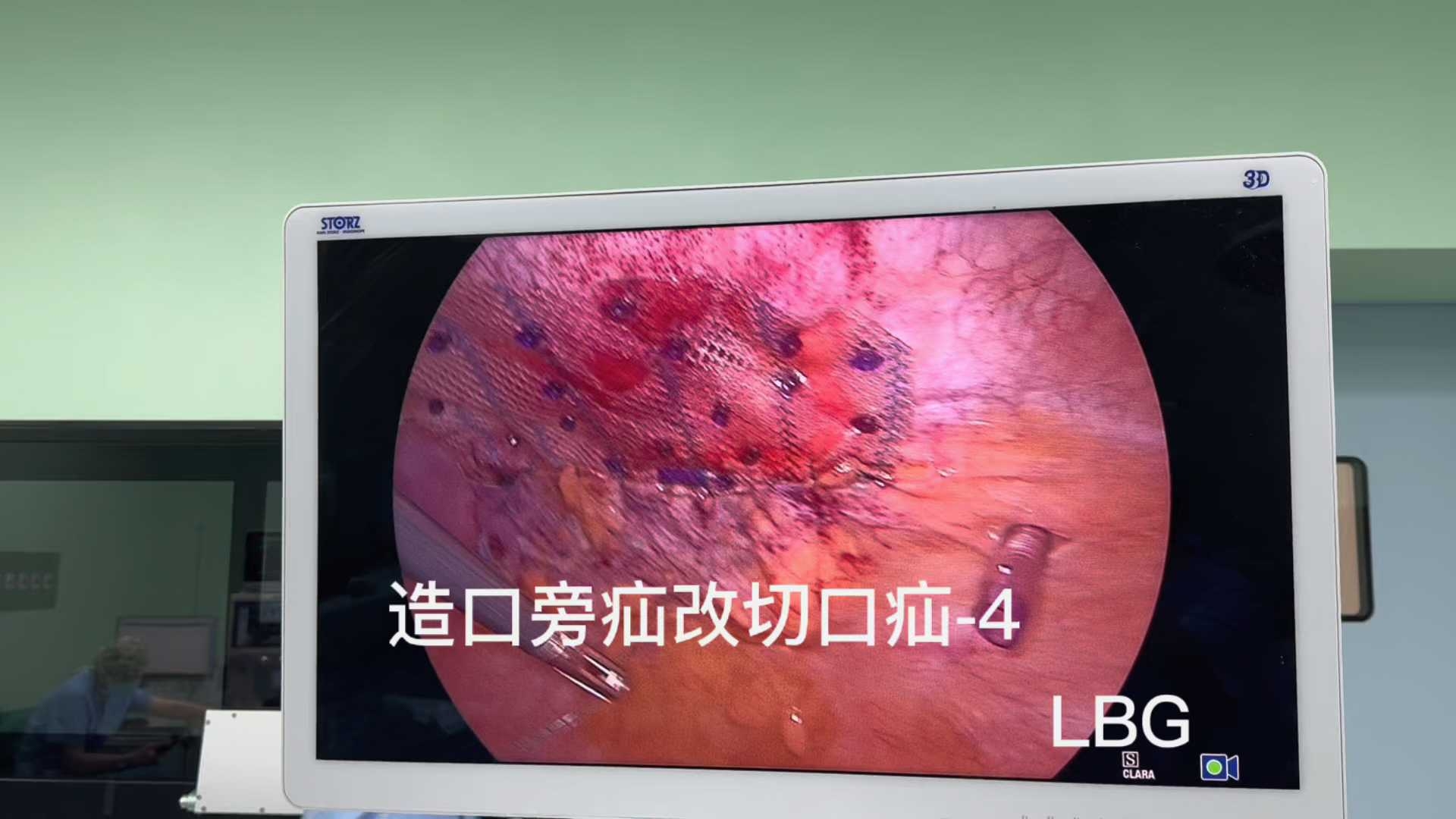造口还瘘 腔镜下tape修补术