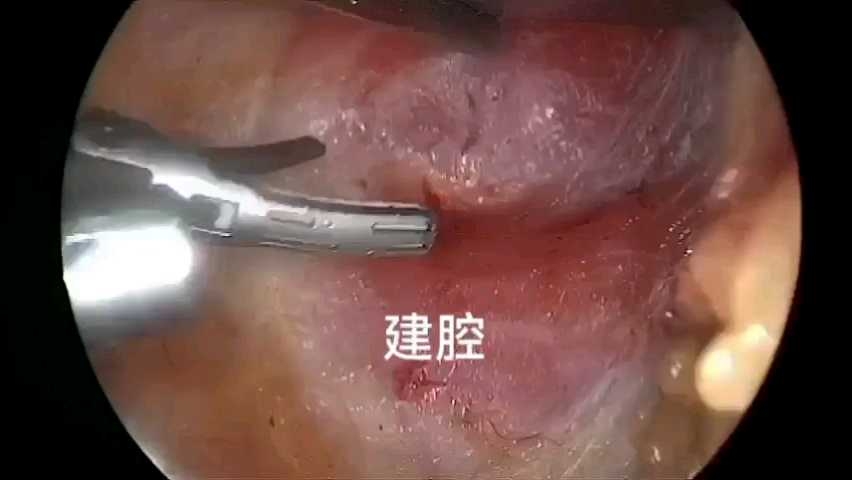 左侧经锁骨腔镜甲状腺手术