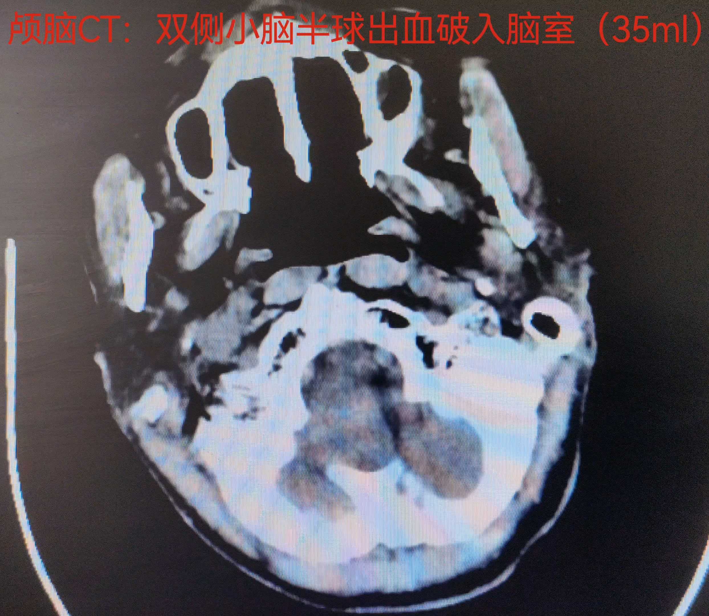 第七届中国医师节献礼 影像学下的脑出血病变