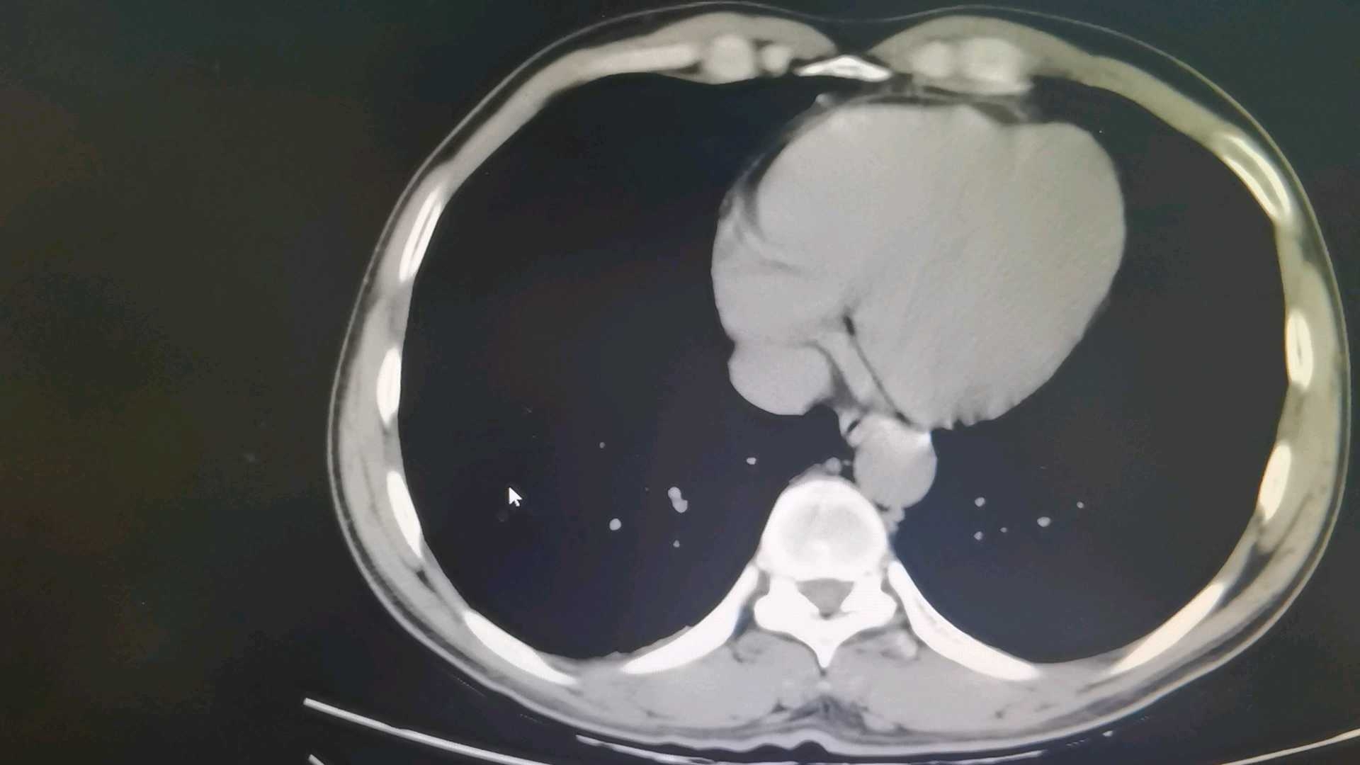胰管结石并胰腺炎的治疗?
