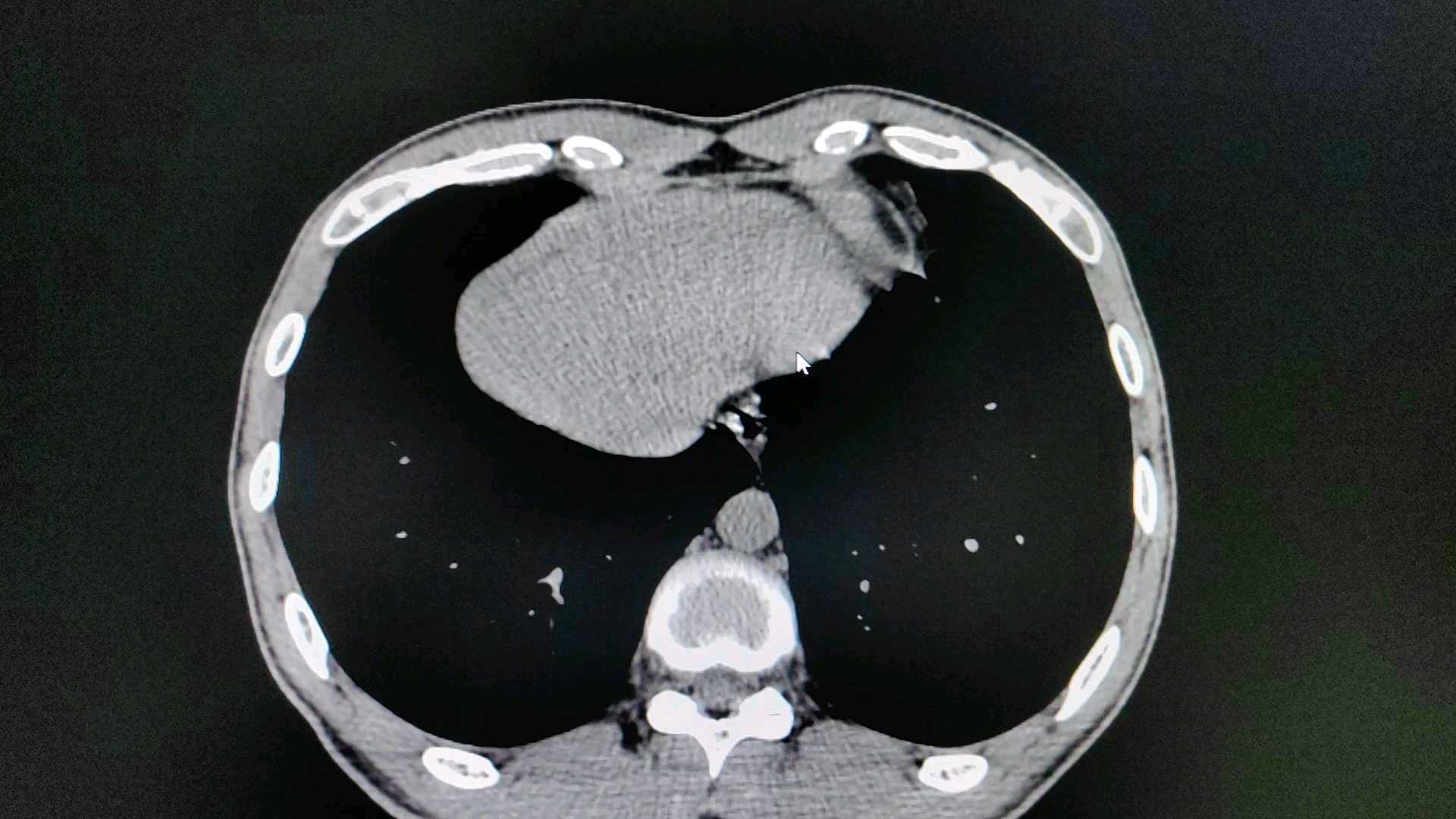 关于结肠憩室炎,大家有何经验分享?
