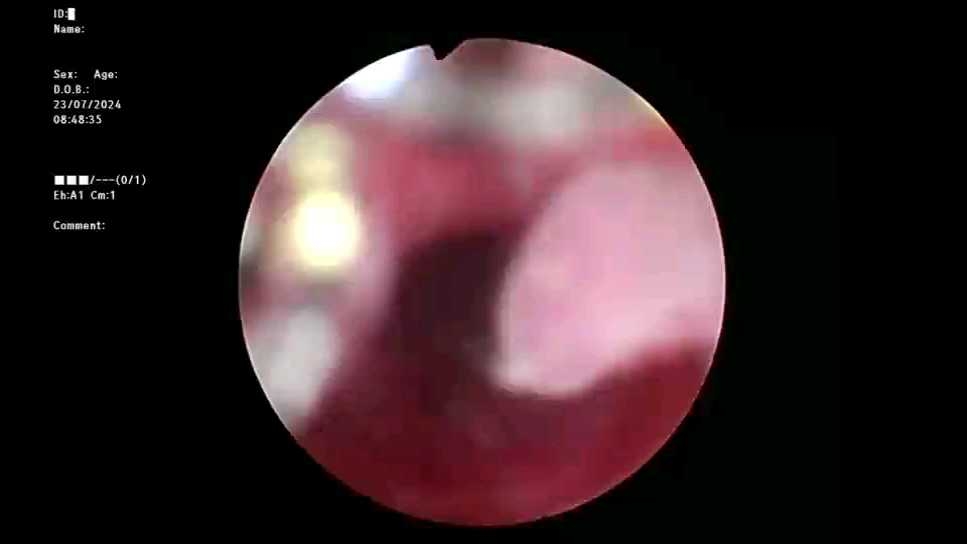 病例#宫腔镜下子宫粘膜下肌瘤(i型)电切术