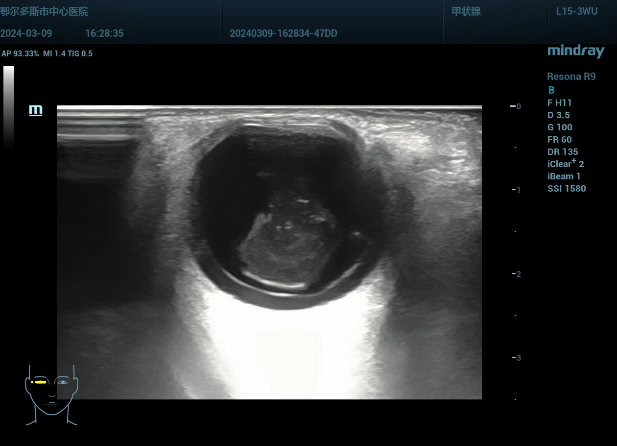 【规培笔记】玻璃体后脱离