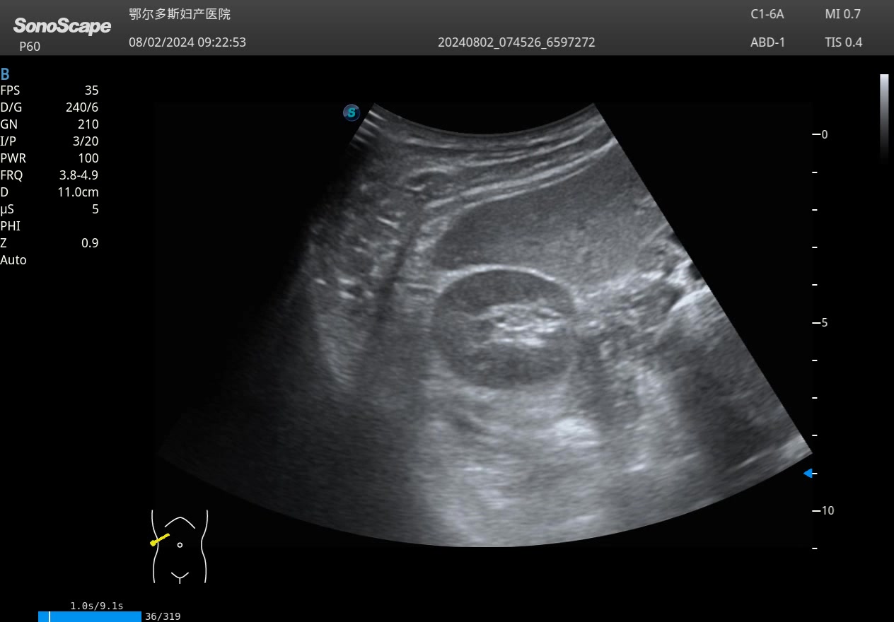 重复肾超声表现图片图片