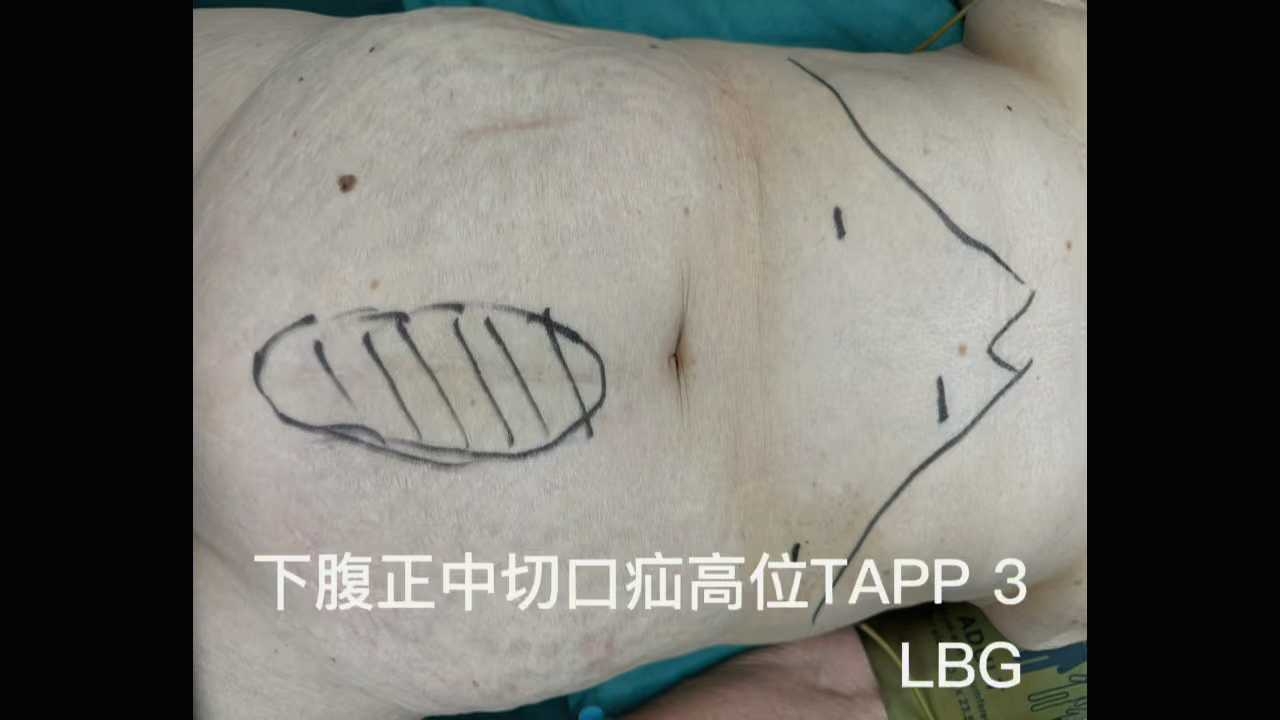 "高位tapp"处理腹壁疝