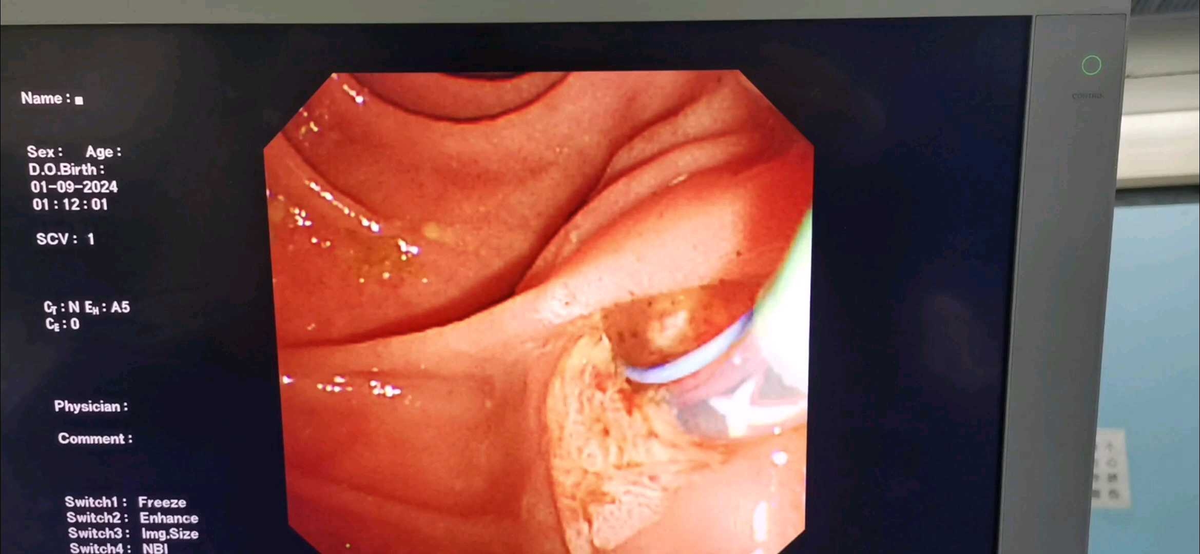 这是今年的第1例急诊ercp