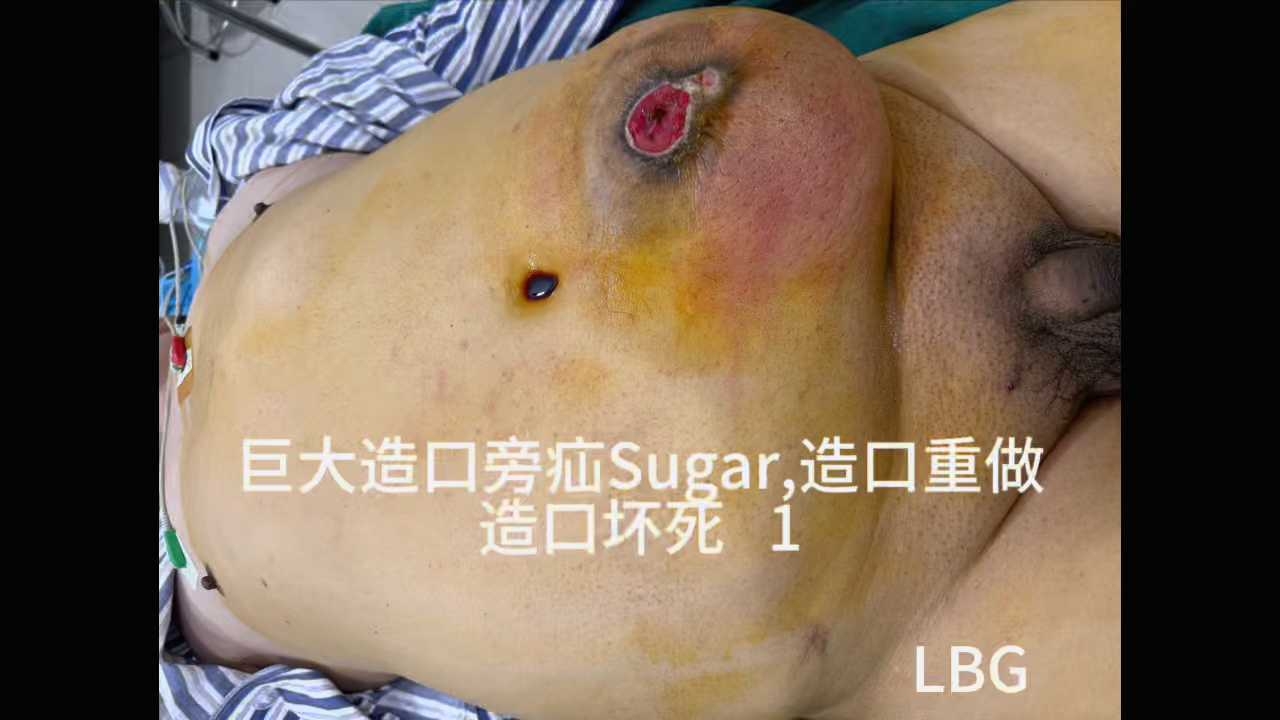 造口旁疝(7)"sugarbaker"修补术 "造口redo" "造口坏死保守治疗"