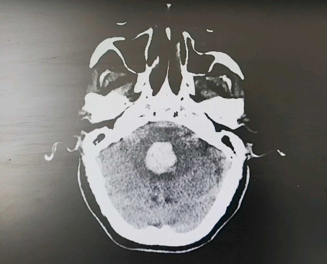 影像学下的脑出血病变