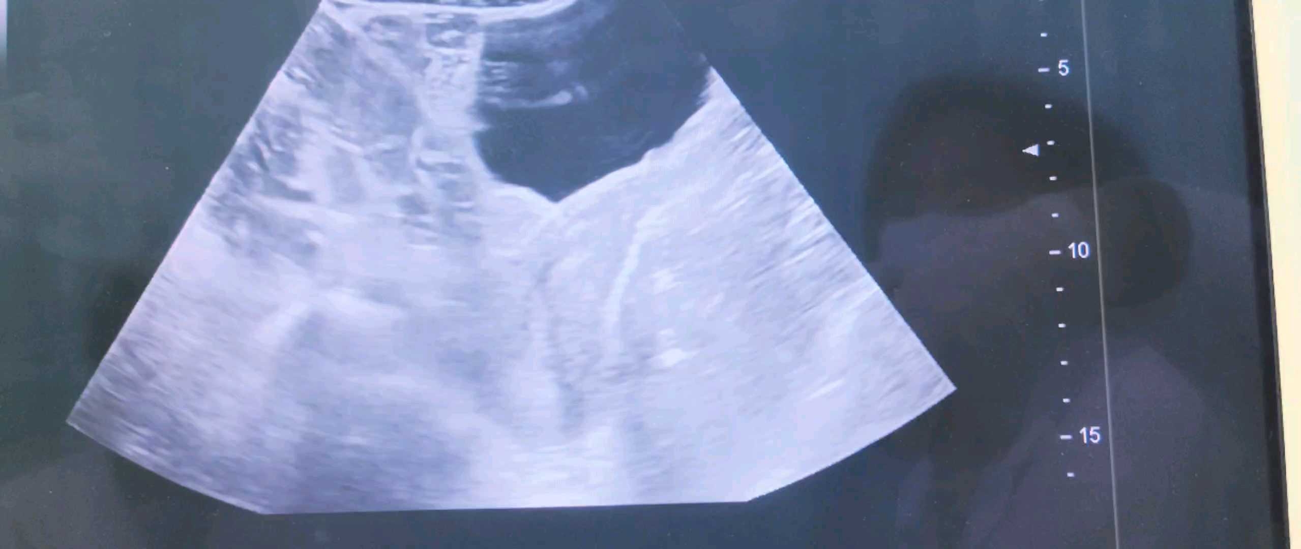 边玩边学—后位子宫超声