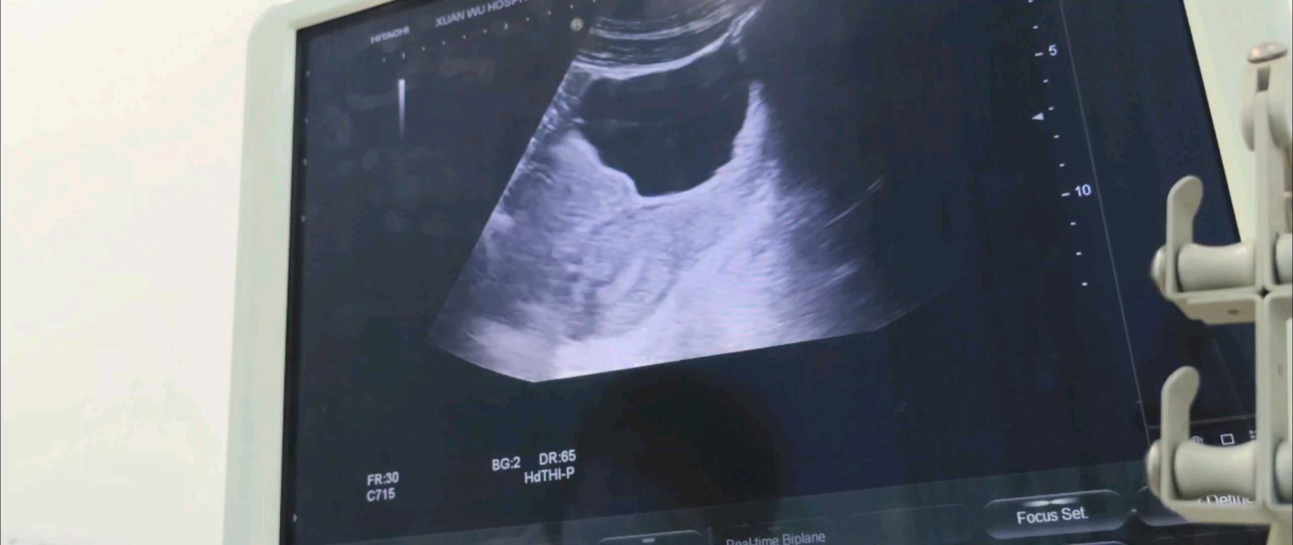 边玩边学—后位子宫超声