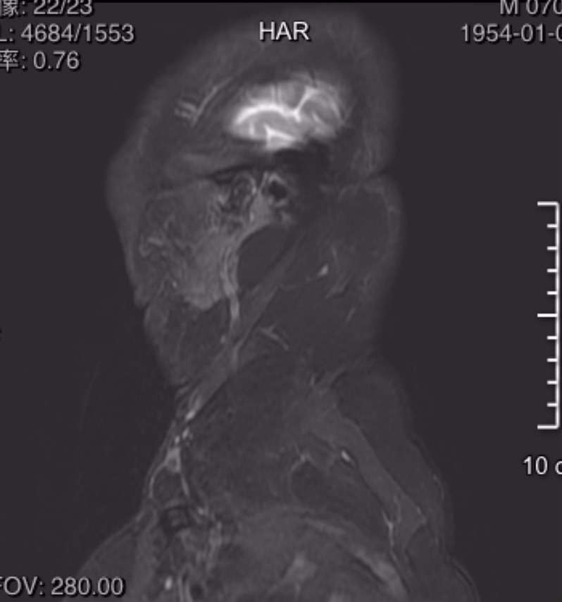 马德龙病又称良性对称性脂肪瘤病1例(benign symmetric lipo-matosis