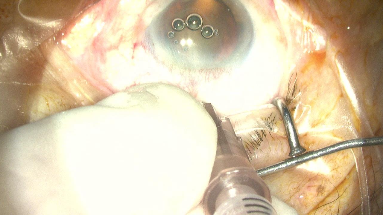 高眼压浅前房的白内障超声乳化术