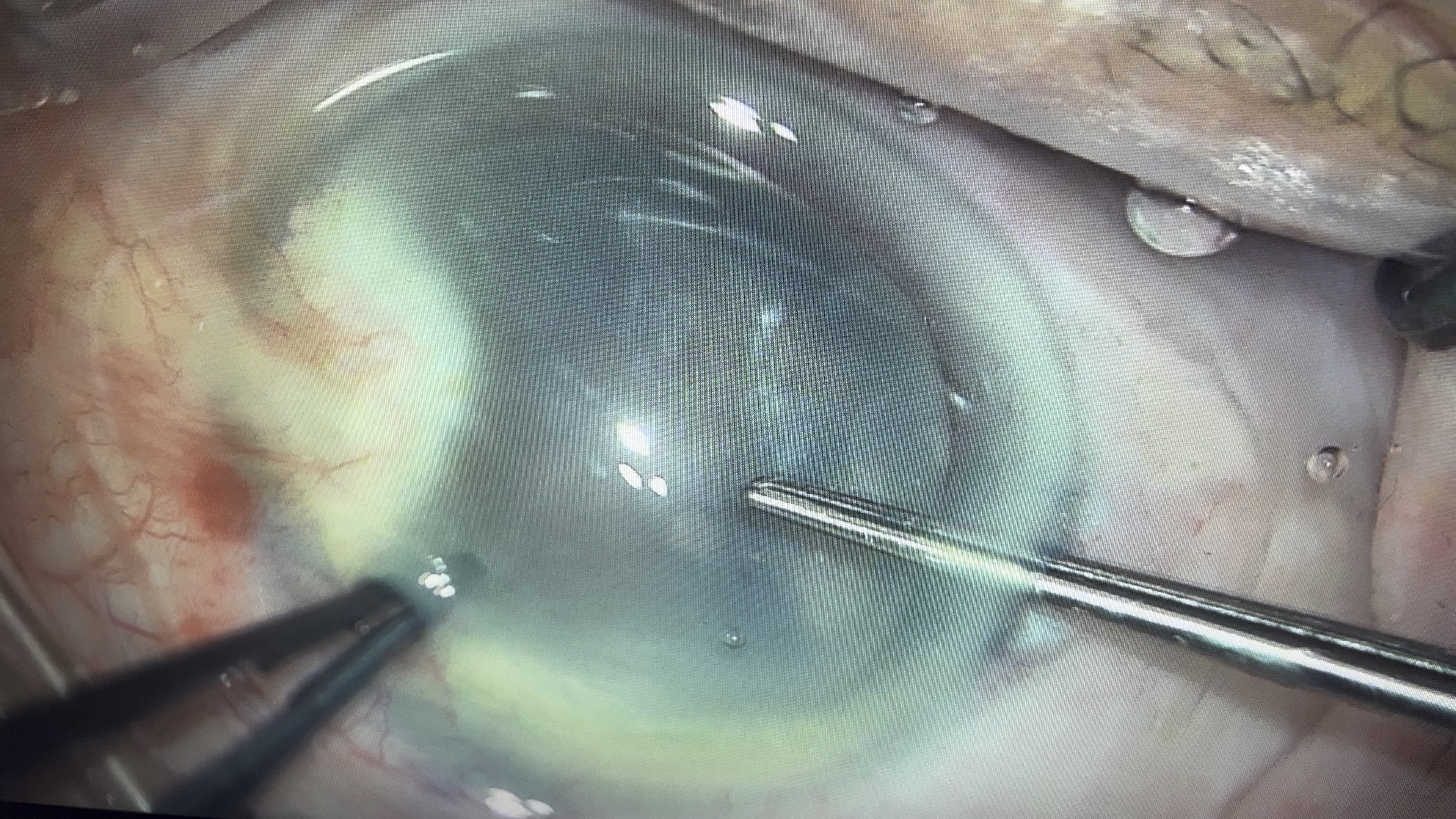 又是一例过熟期白内障