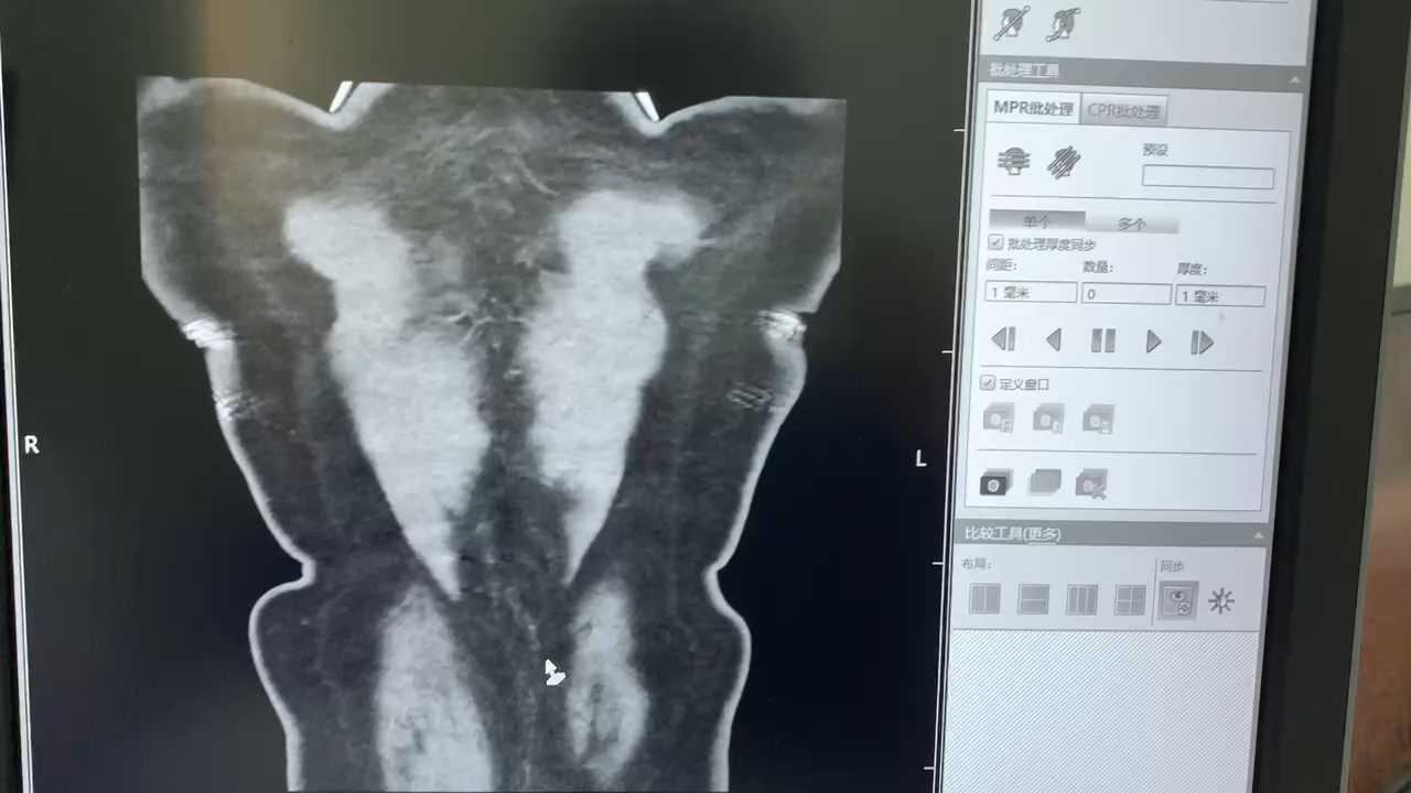 胸部ct(永存左上腔静脉)