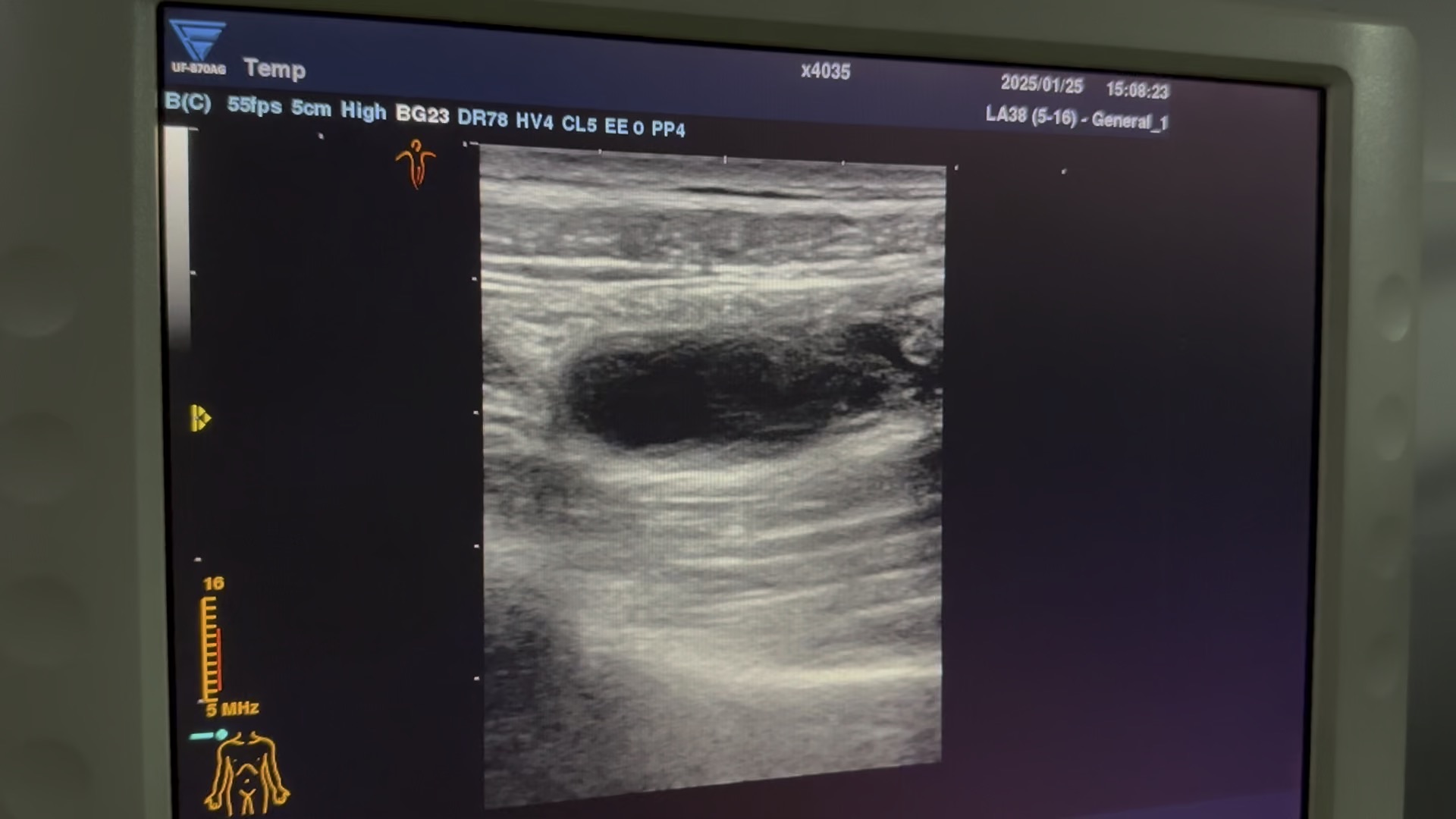 阑尾炎,超声和ct影像,手术