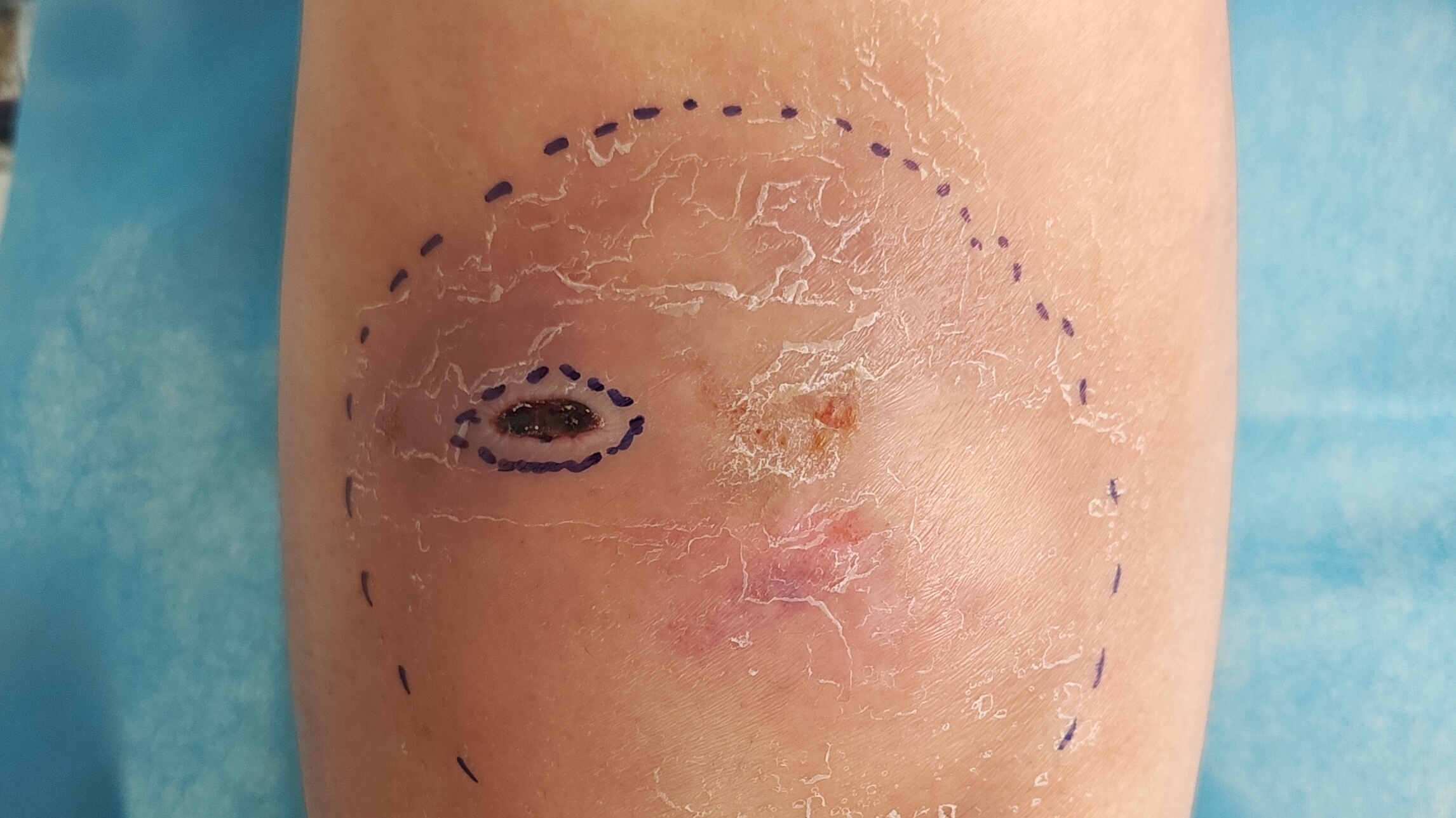 电动车撞伤后血肿切开引流术